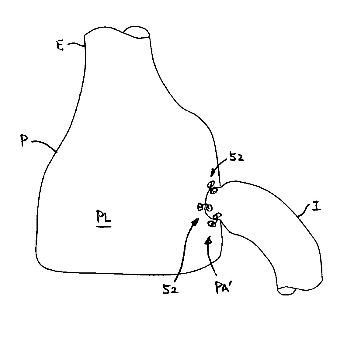 Methods and apparatus for revision of obesity procedures