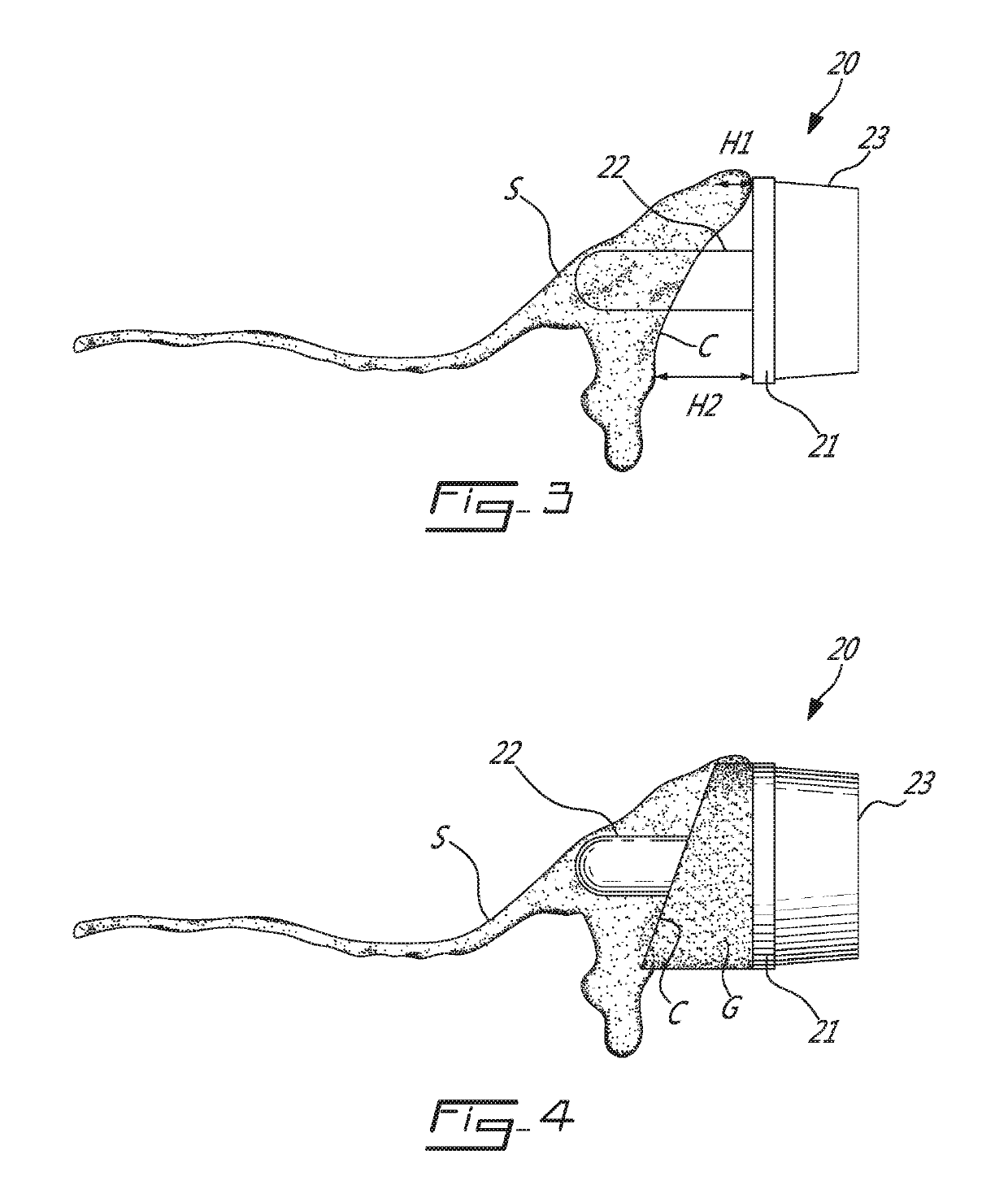 Patient-specific bone grafting system and method