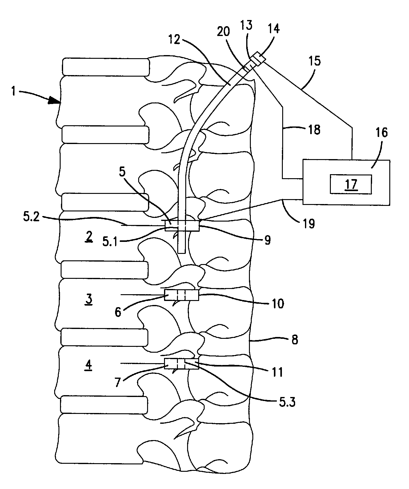Medical device for determining the position of intracorporeal implants