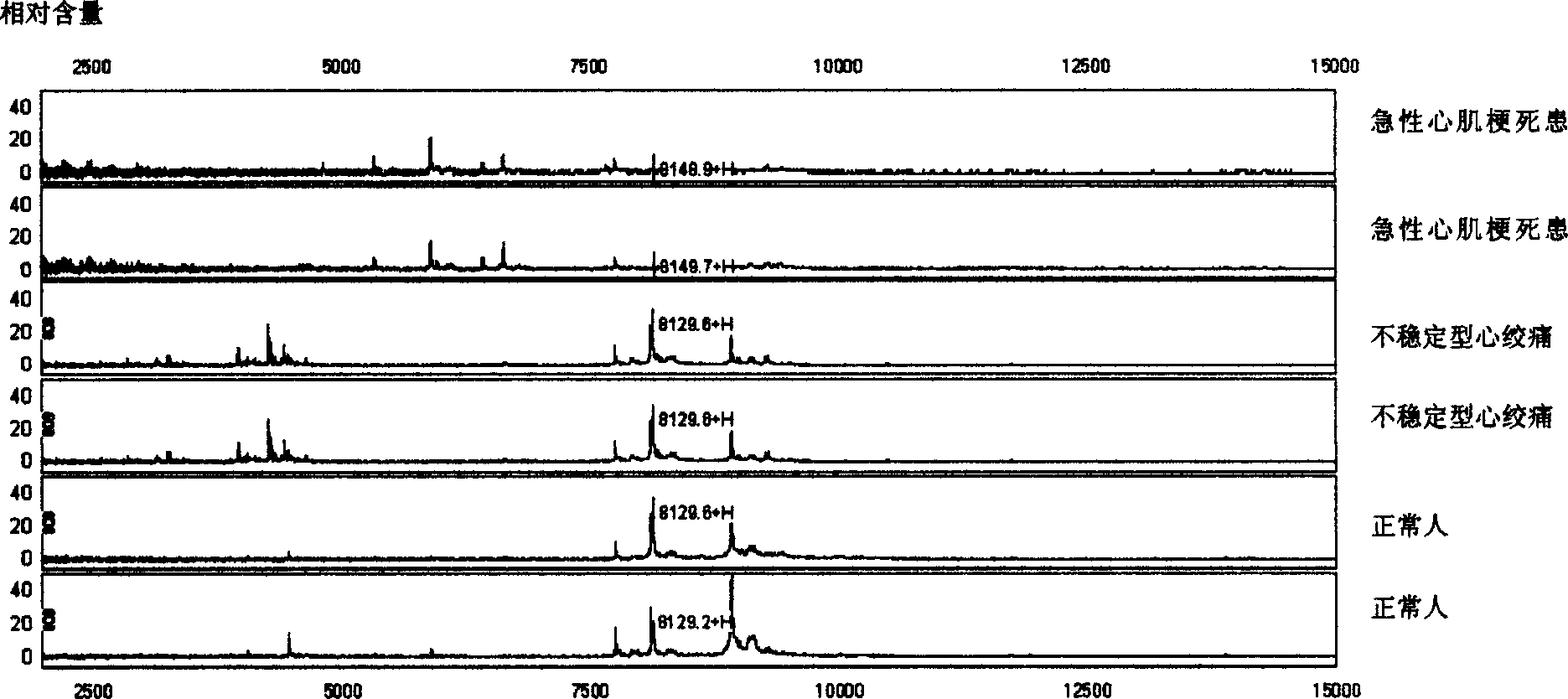 Method for diagnostic acute myocardial infarction using serum specific protein group finger print atlas