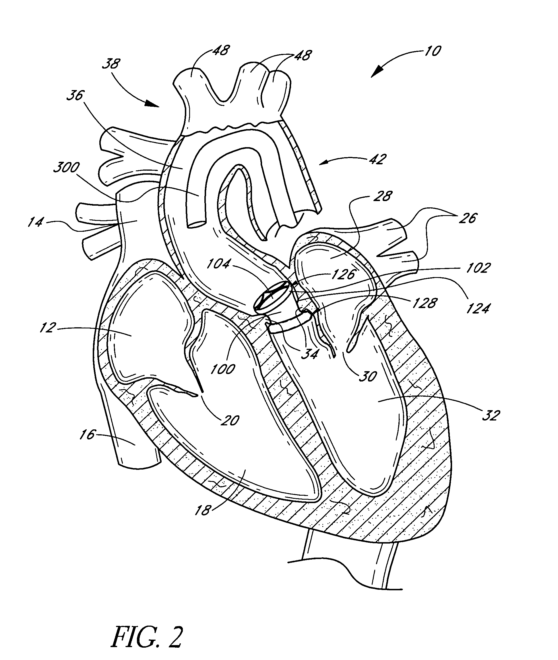 Nonstented temporary valve for cardiovascular therapy