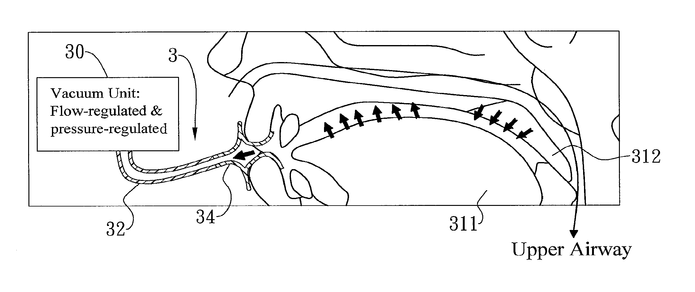 Method and apparatus for treating obstructive sleep apnea by using negative oral pressure to a patient