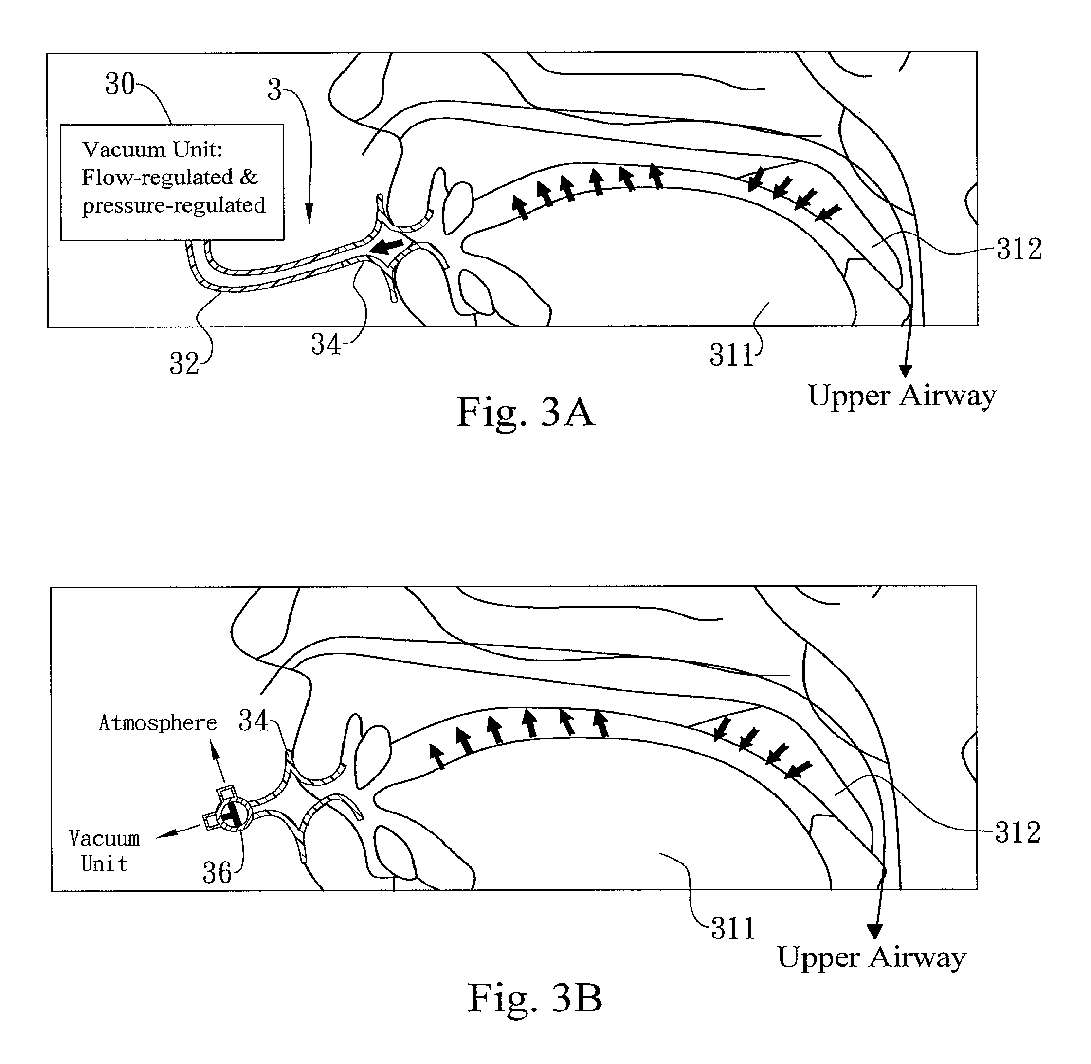 Method and apparatus for treating obstructive sleep apnea by using negative oral pressure to a patient