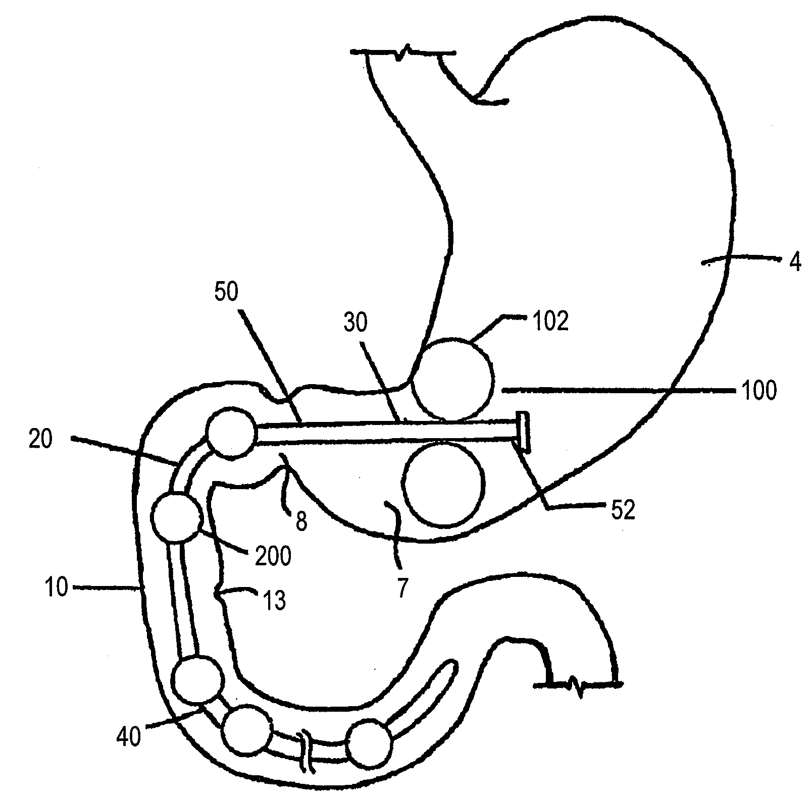Conformationally-Stabilized Intraluminal Device for Medical Applications