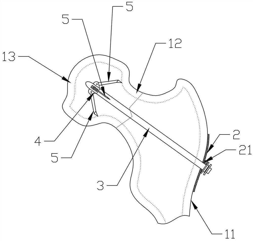 Internal supporting type fixing device for femoral neck fracture