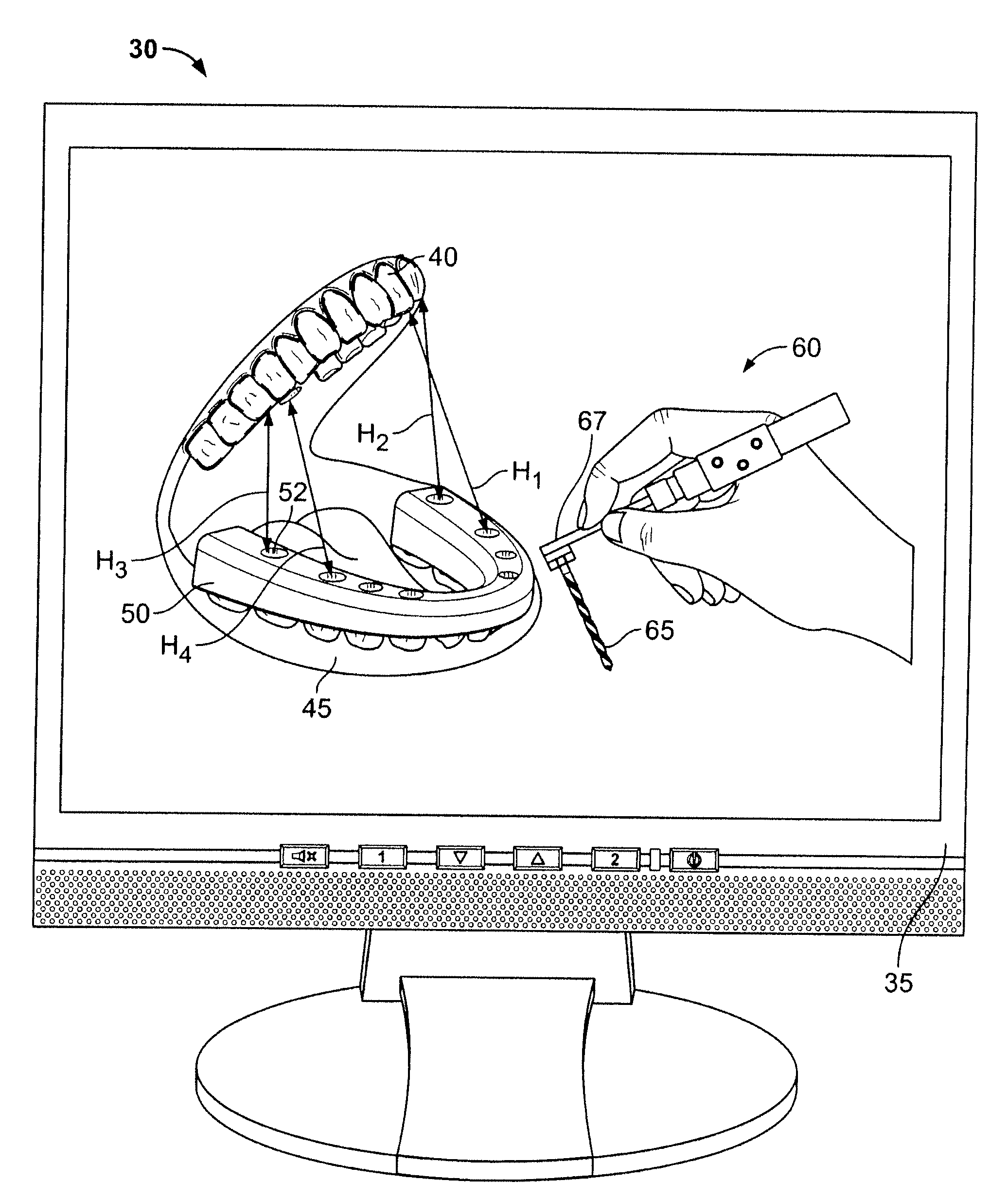 Method for pre-operative visualization of instrumentation used with a surgical guide for dental implant placement