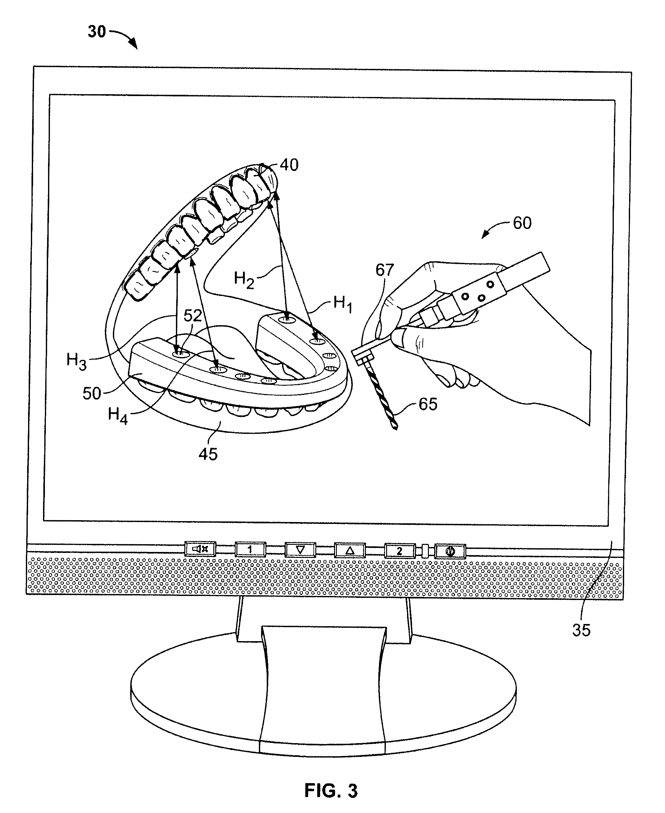 Method for pre-operative visualization of instrumentation used with a surgical guide for dental implant placement