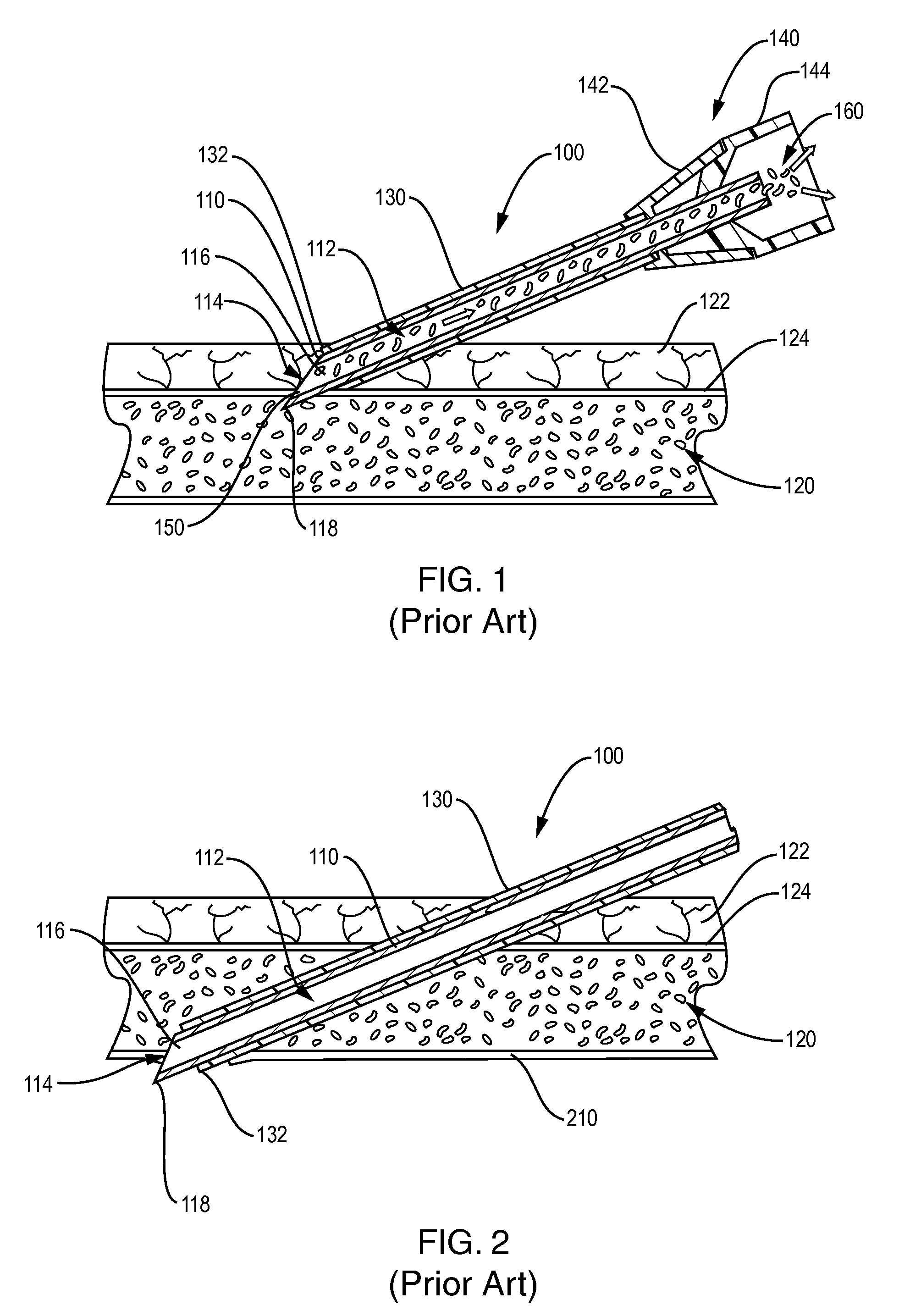 Intravascular needle and catheter assembly