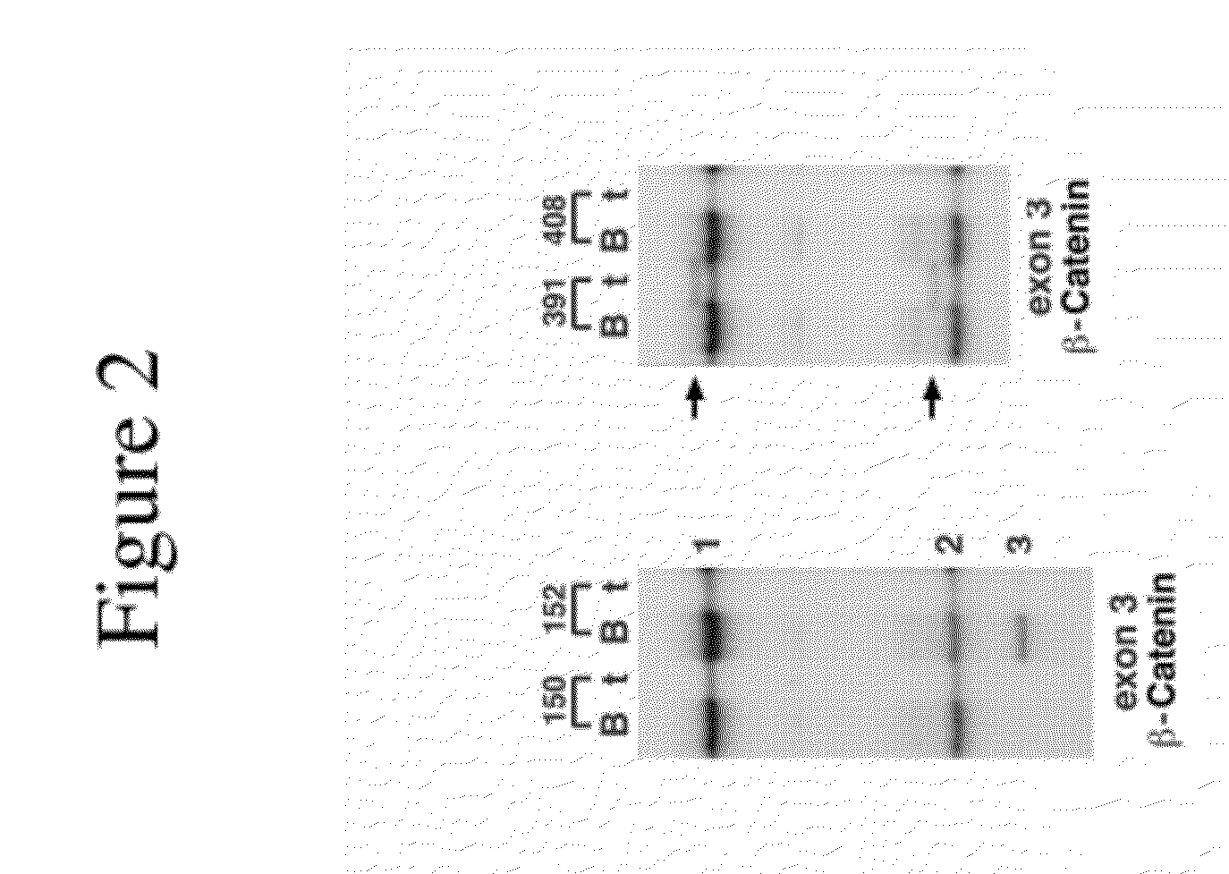 Method of diagnosing and treating cancer using b-catenin splice variants