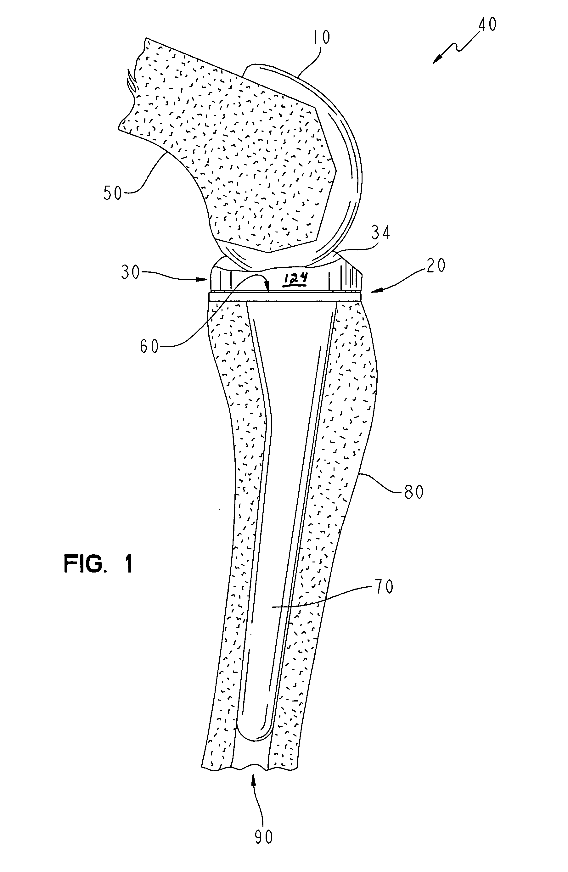 Modular implant with a micro-motion damper