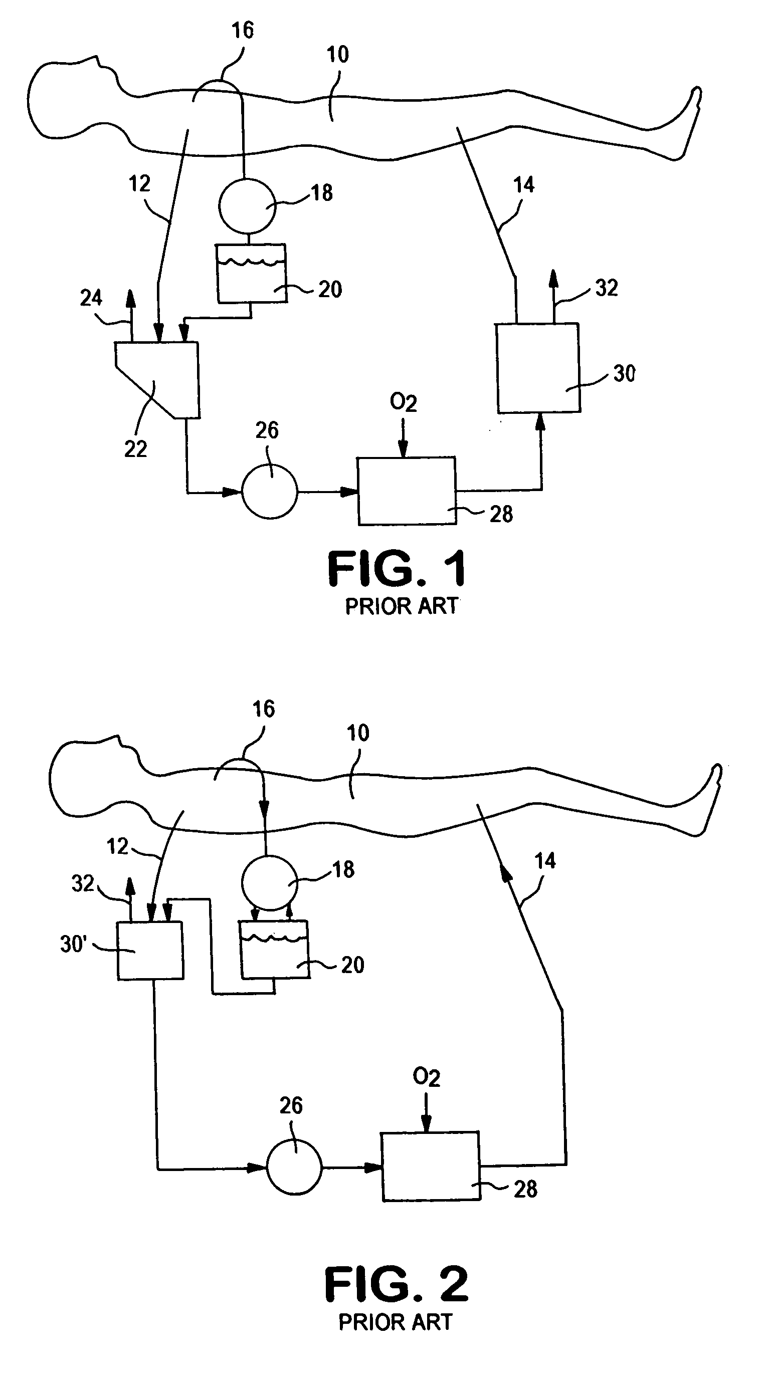 Active air removal from an extracorporeal blood circuit
