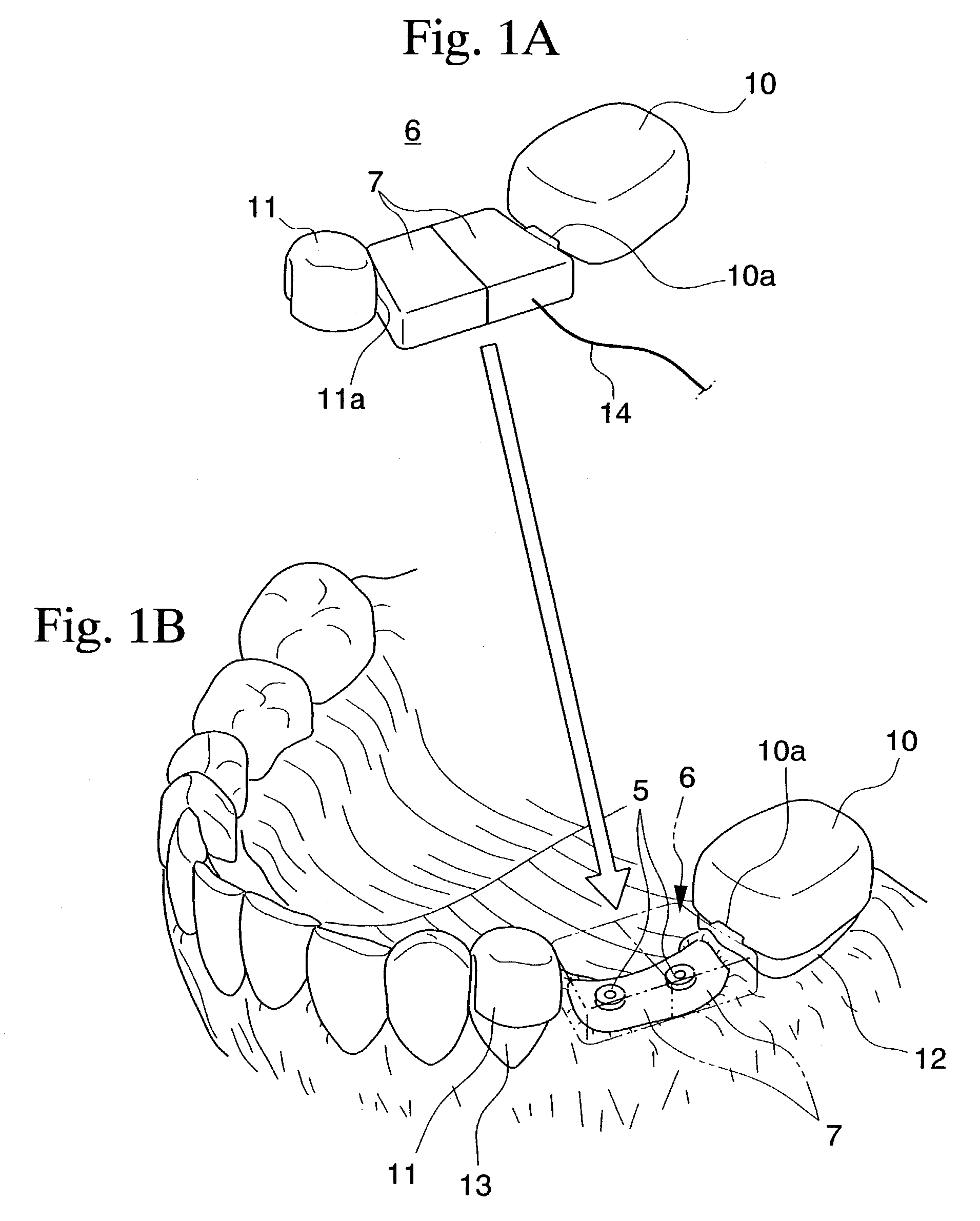 Ultrasonic therapy device for dental implant and therapy method therefor