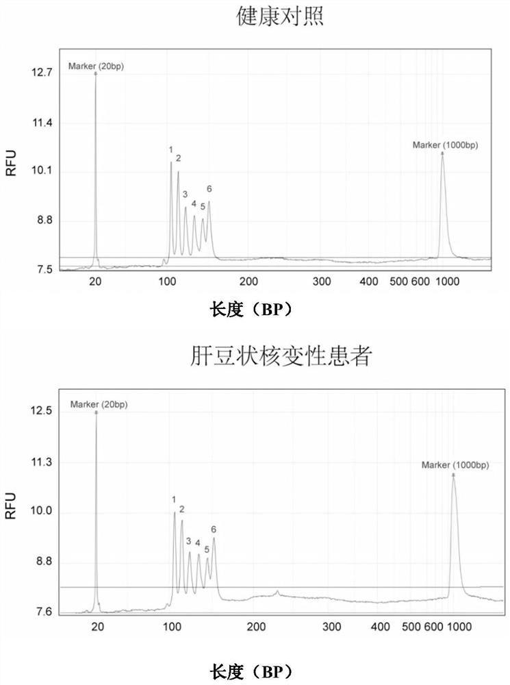 Atp7b Gene Large Fragment Deletion Detection Kit and Detection Method