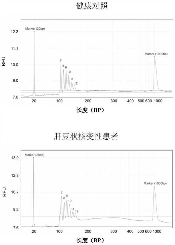 Atp7b Gene Large Fragment Deletion Detection Kit and Detection Method