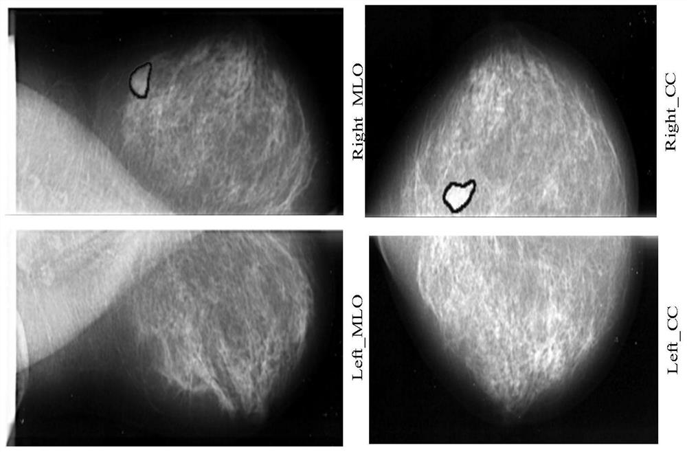 Mammary gland disease AI auxiliary diagnosis method based on molybdenum target X-ray photography examination