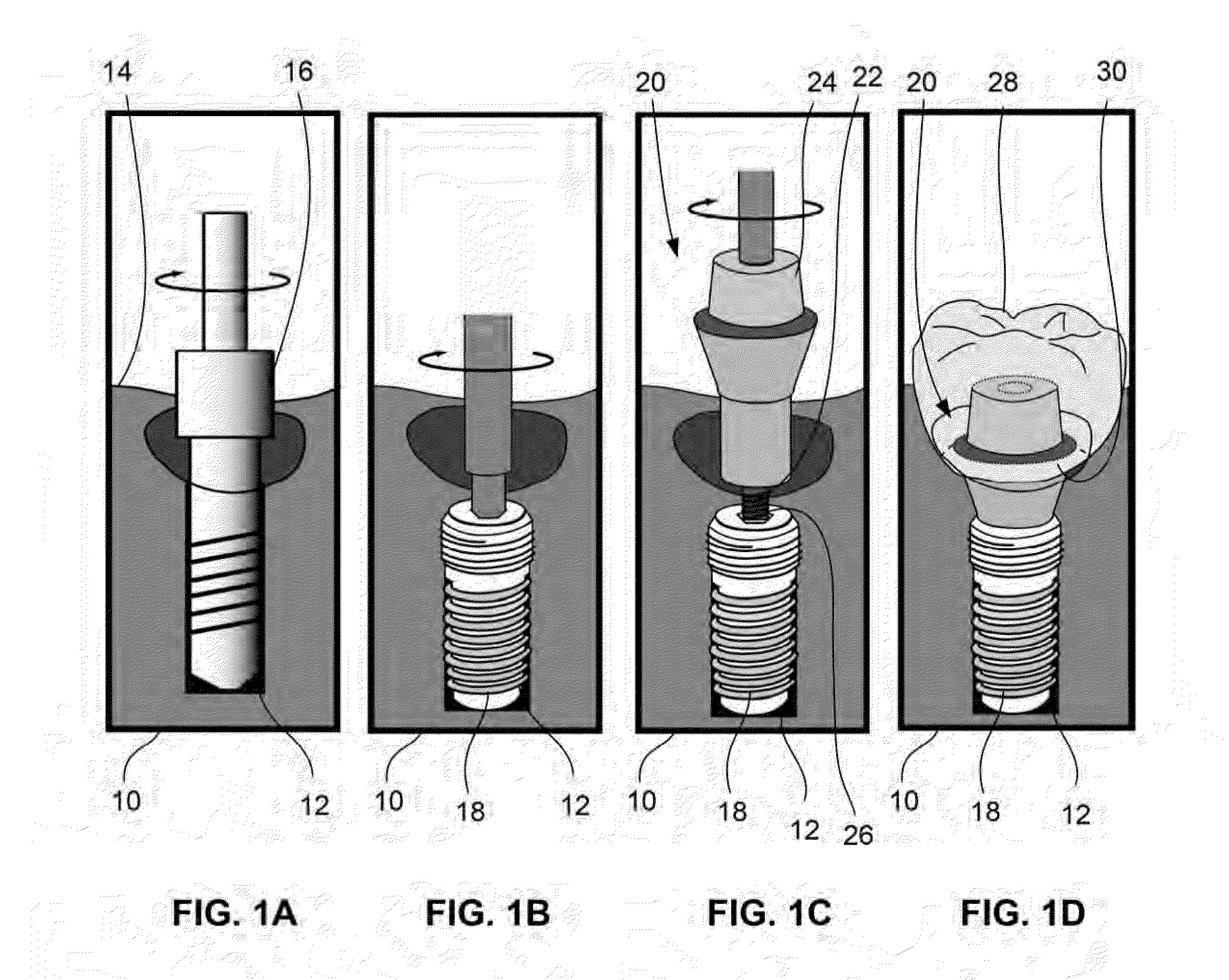 Dental prostheses devices and methods