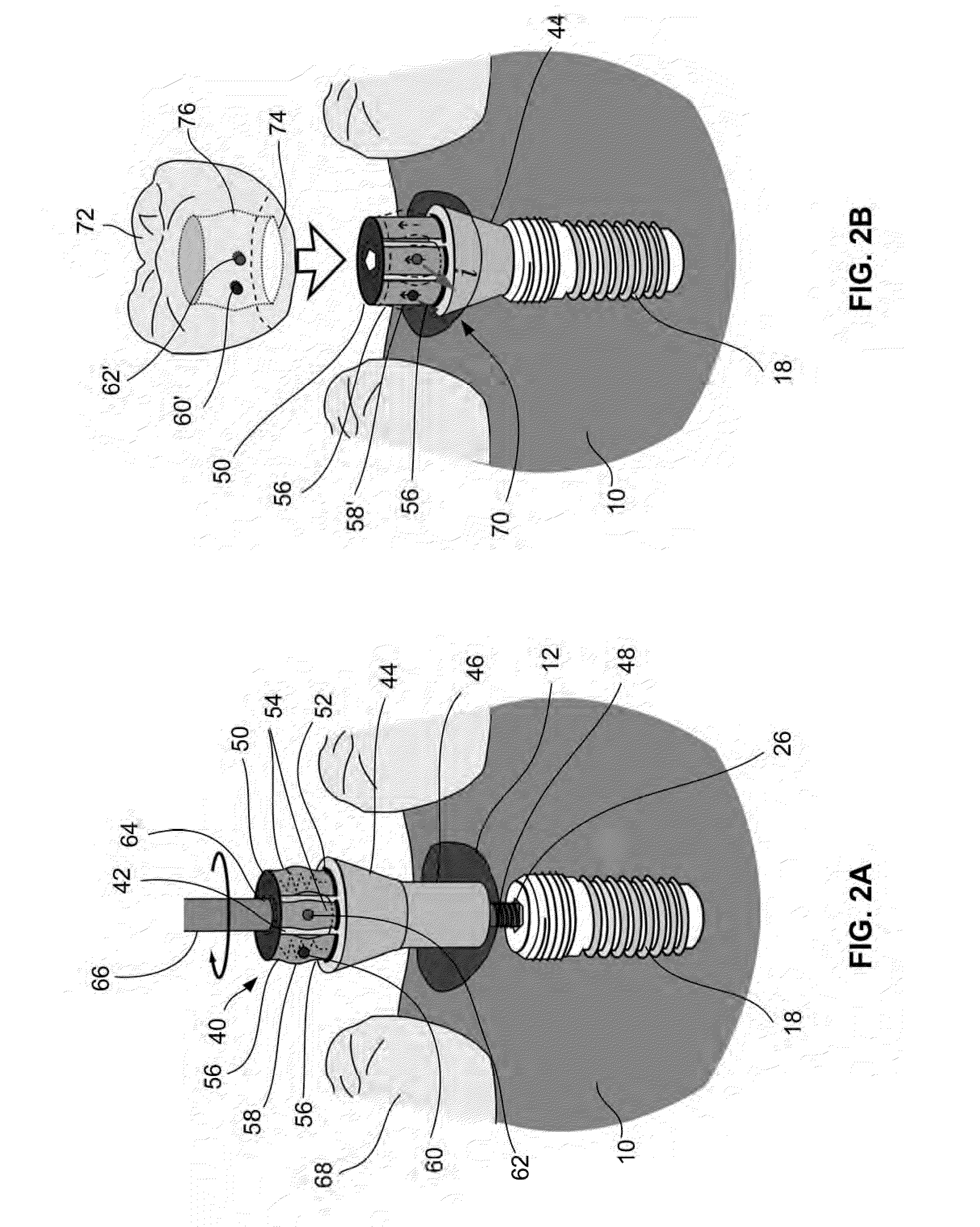 Dental prostheses devices and methods