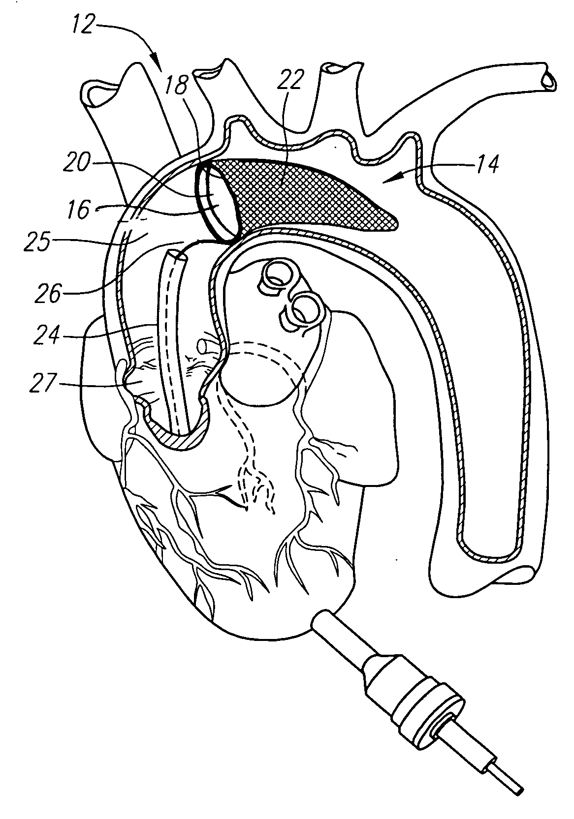 Method and assembly for distal embolic protection