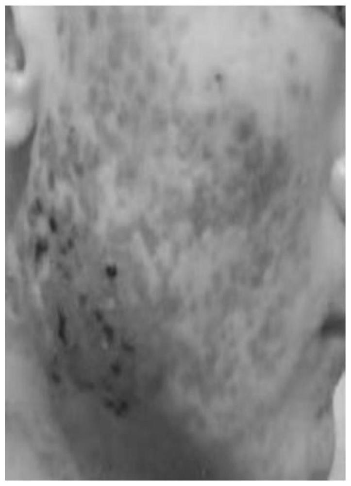 Skin injury repairing preparation as well as preparation method and application thereof