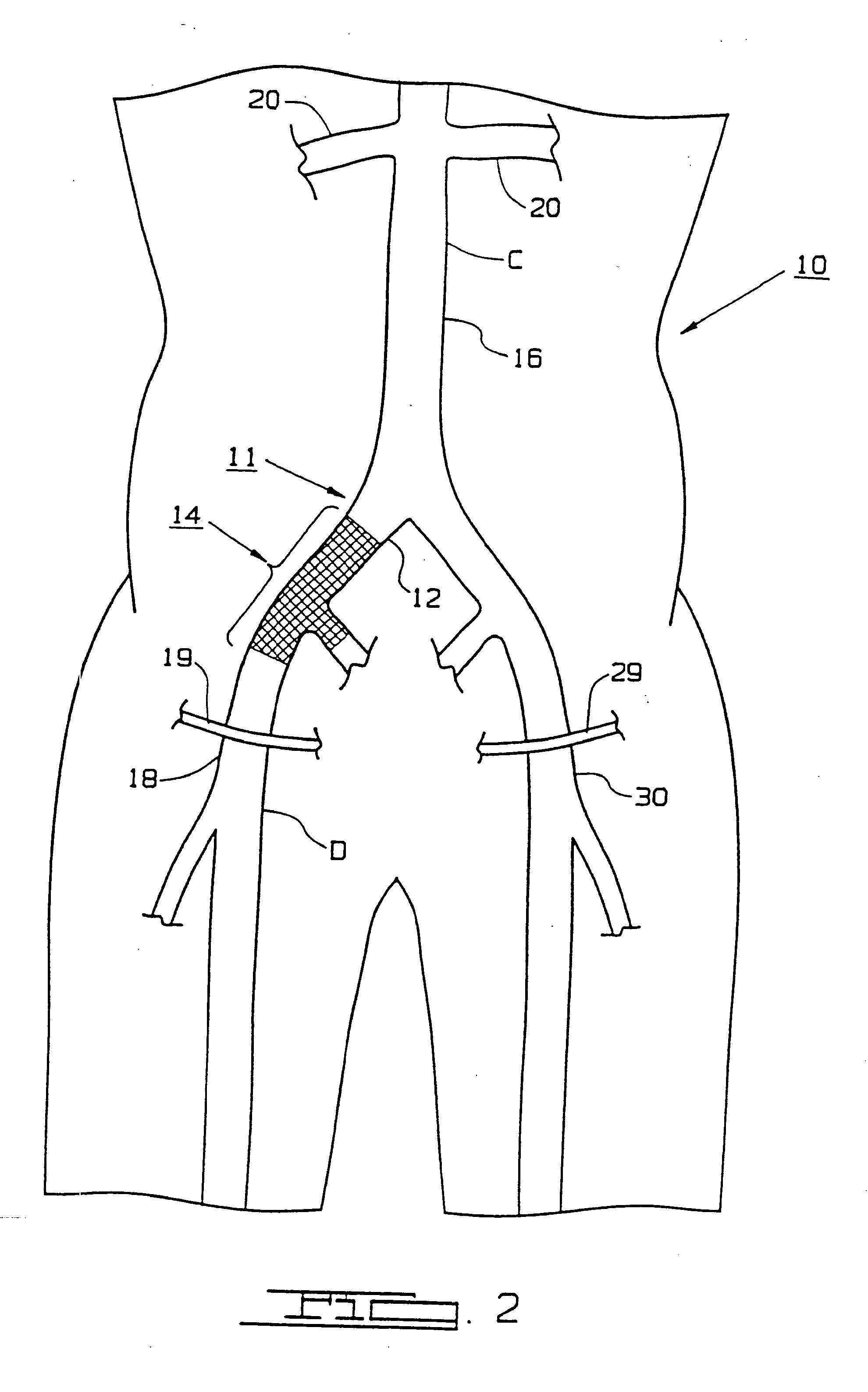 Bypass Grafting System and Apparatus