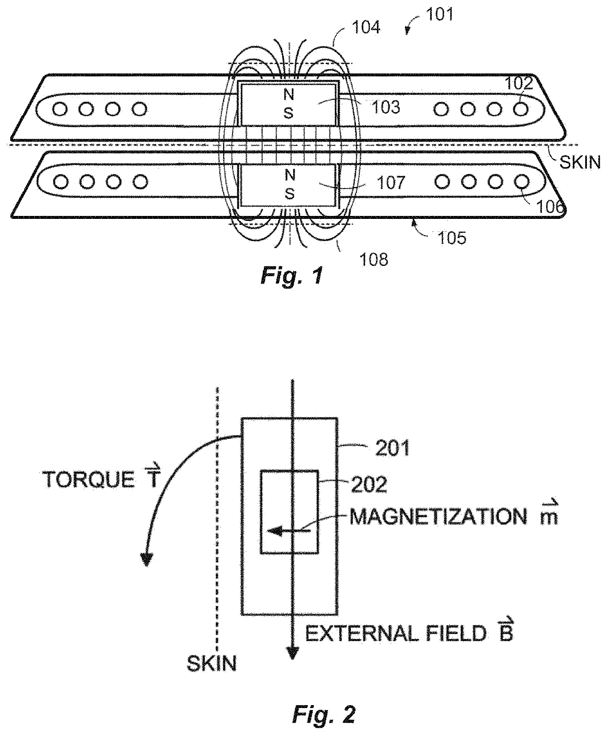 Holding Magnets and Magnet System for Implantable Systems Optimized for MRI