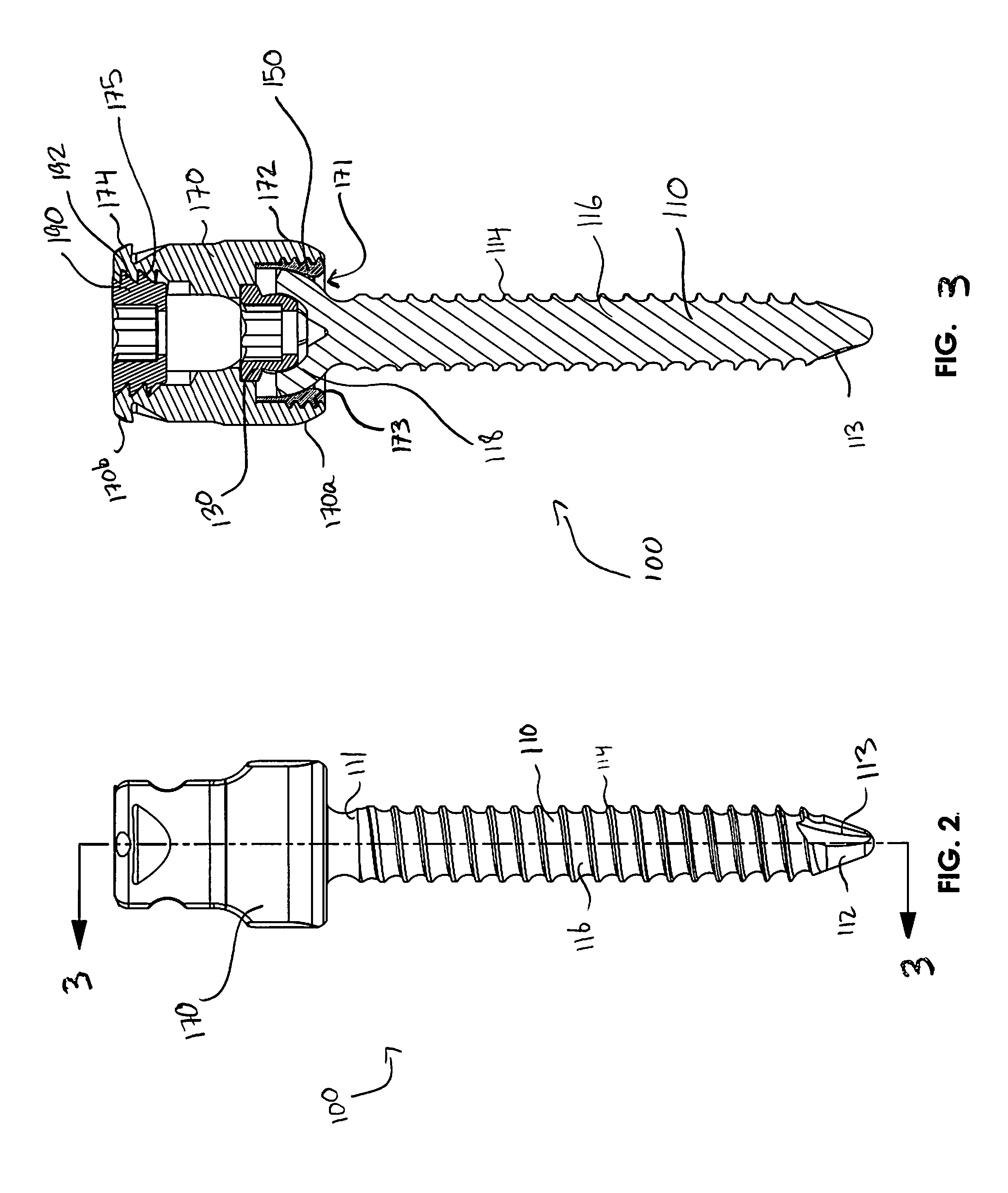 Bone screw assembly with non-uniform material