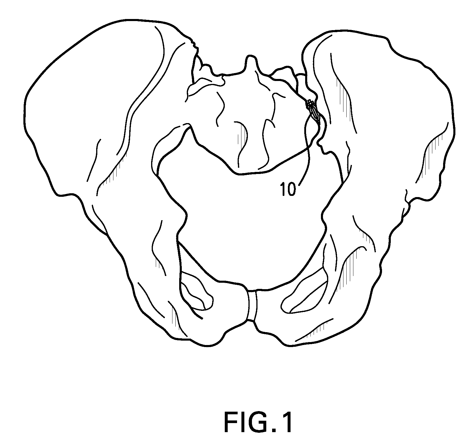 Methods of stabilizing the sacroiliac joint