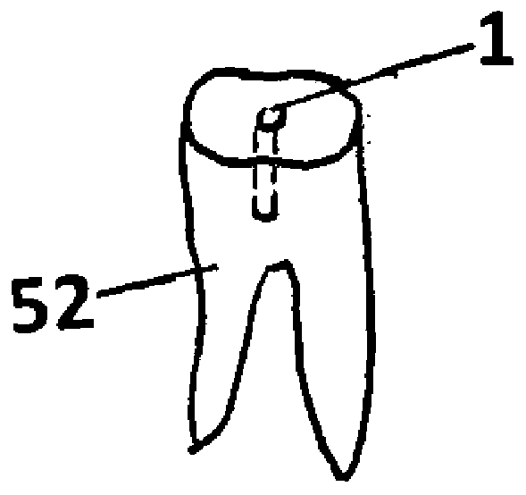 Dental implantation method and corresponding dental implant