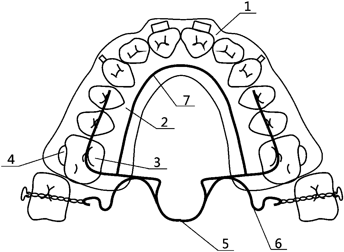 A film-type ortholocking orthodontic device for posterior teeth and its preparation method