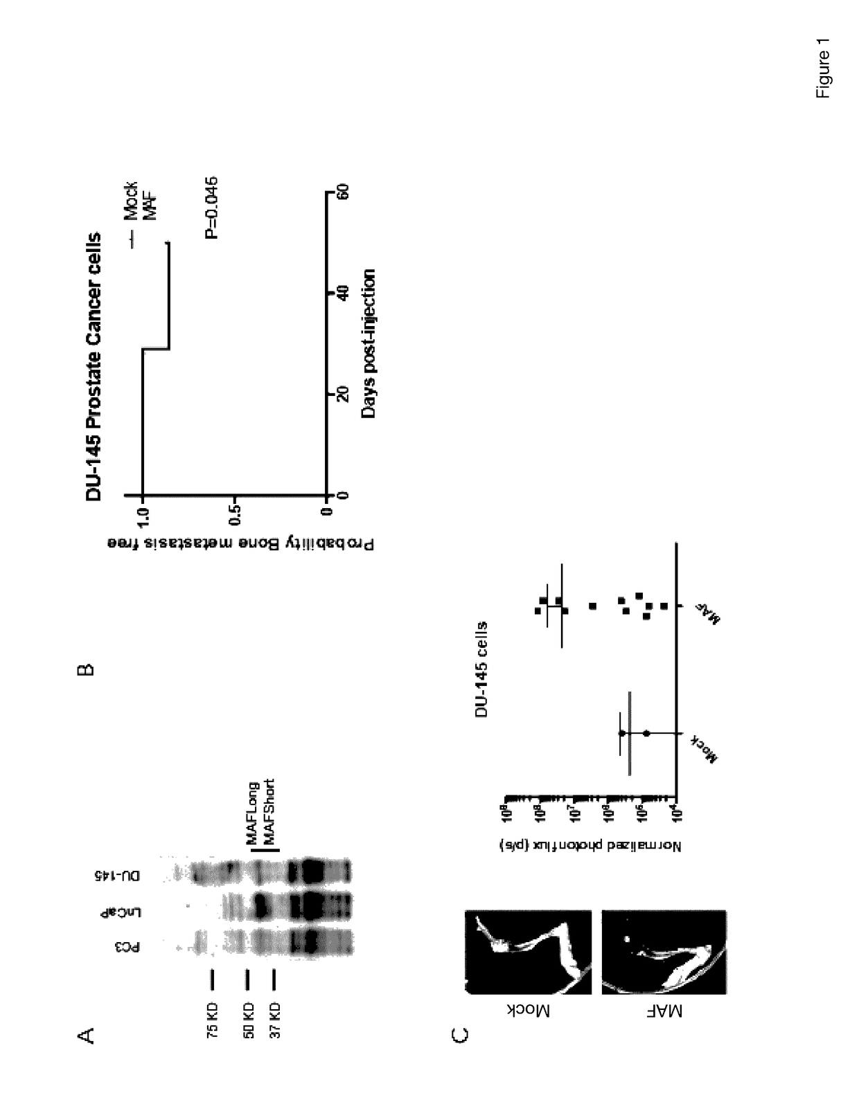 Method for the Diagnosis, Prognosis and Treatment of Prostate Cancer Metastasis