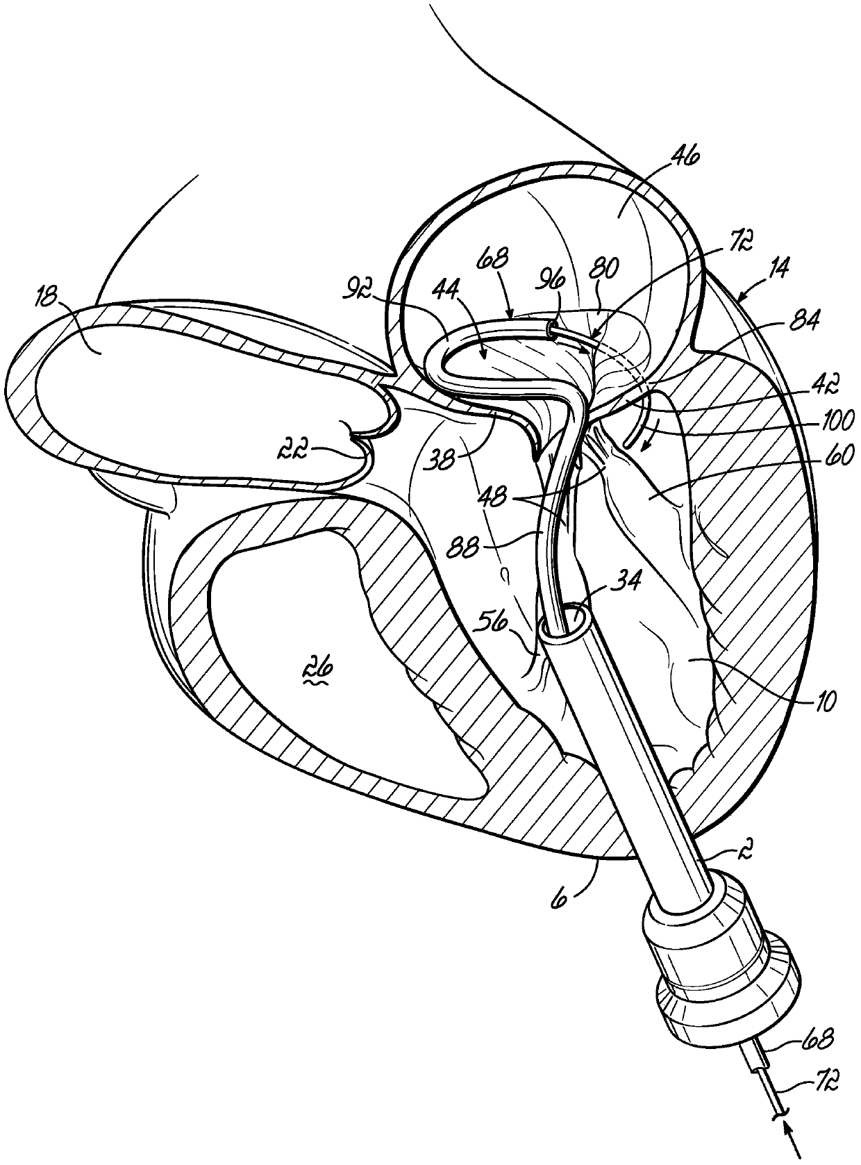 Mitral valve docking devices, systems and methods