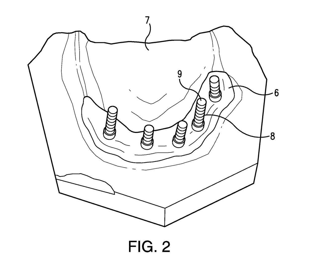 Apparatuses and methods for making a final hybrid prosthesis to be attached to dental implants