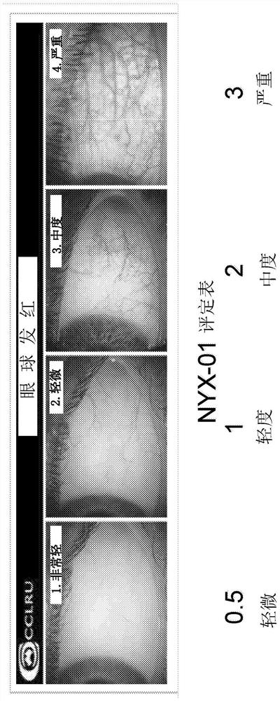 Methods and compositions for treatment of glaucoma and related conditions