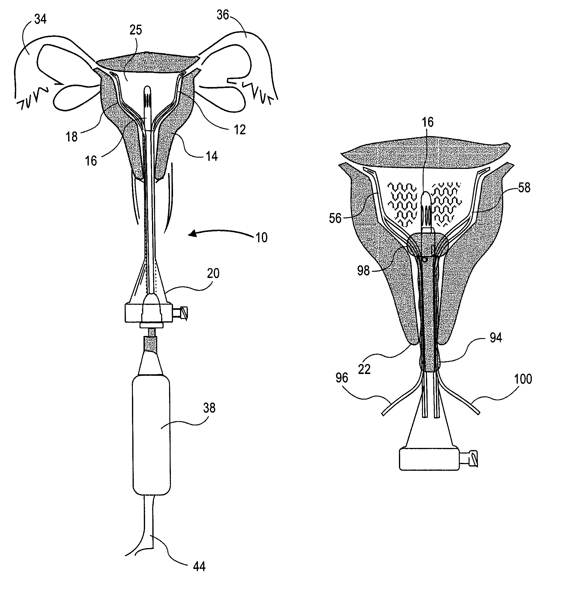 Uterine therapy device and method
