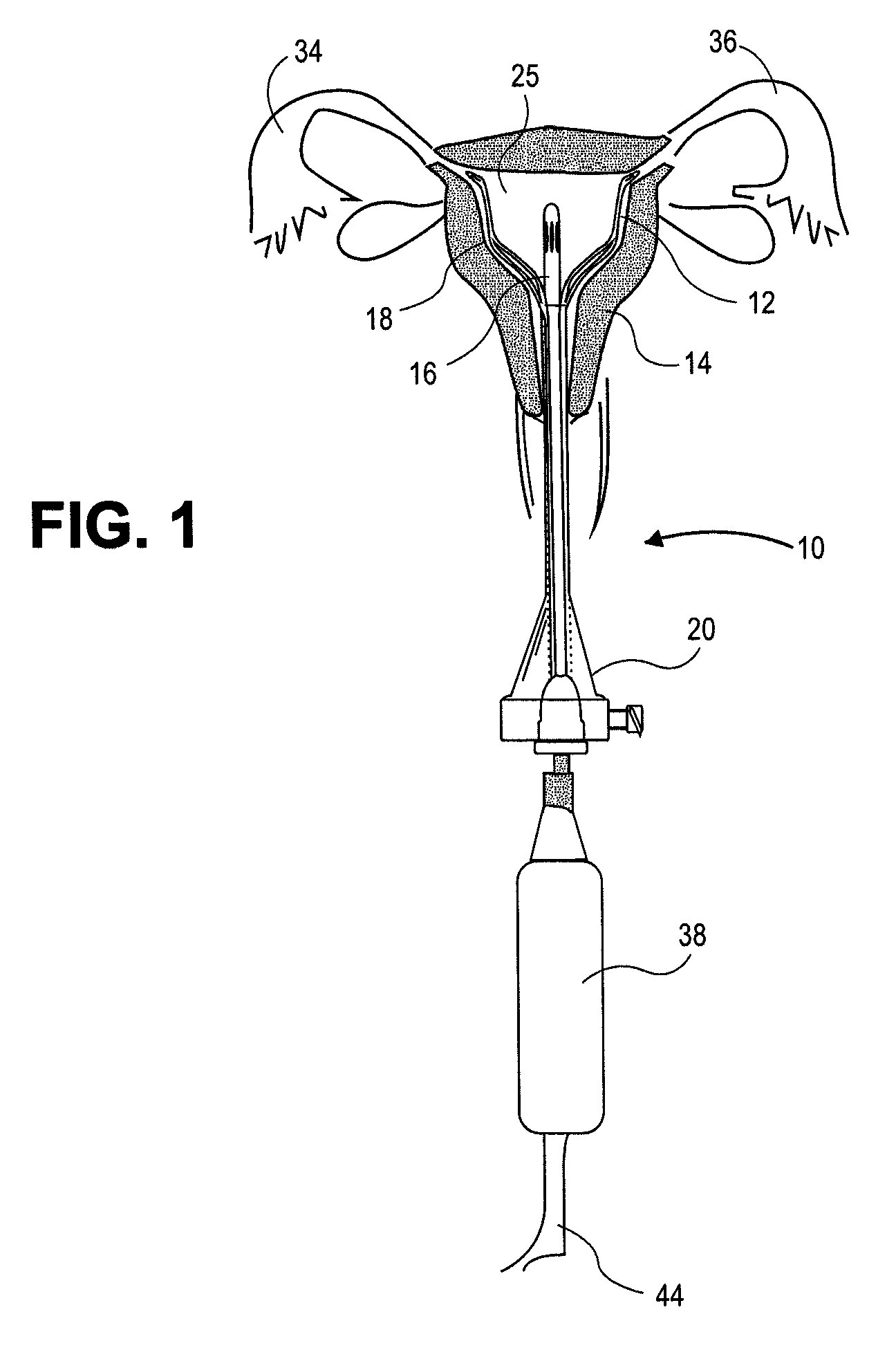 Uterine therapy device and method