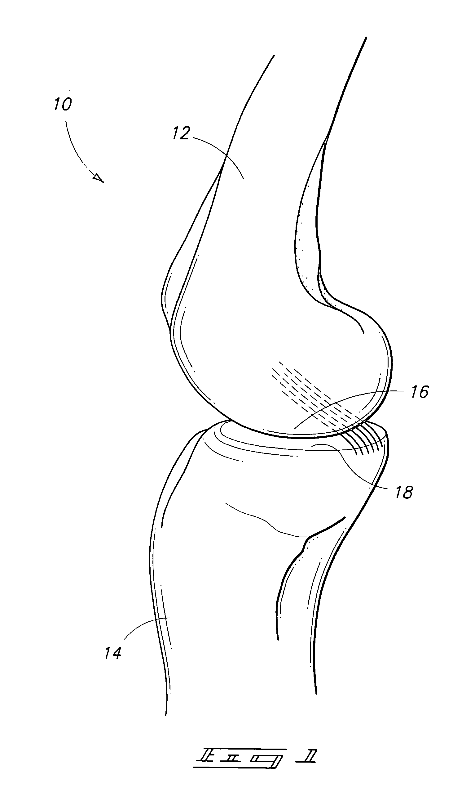 Joint replacement prosthesis, joint replacement mounting stud and method