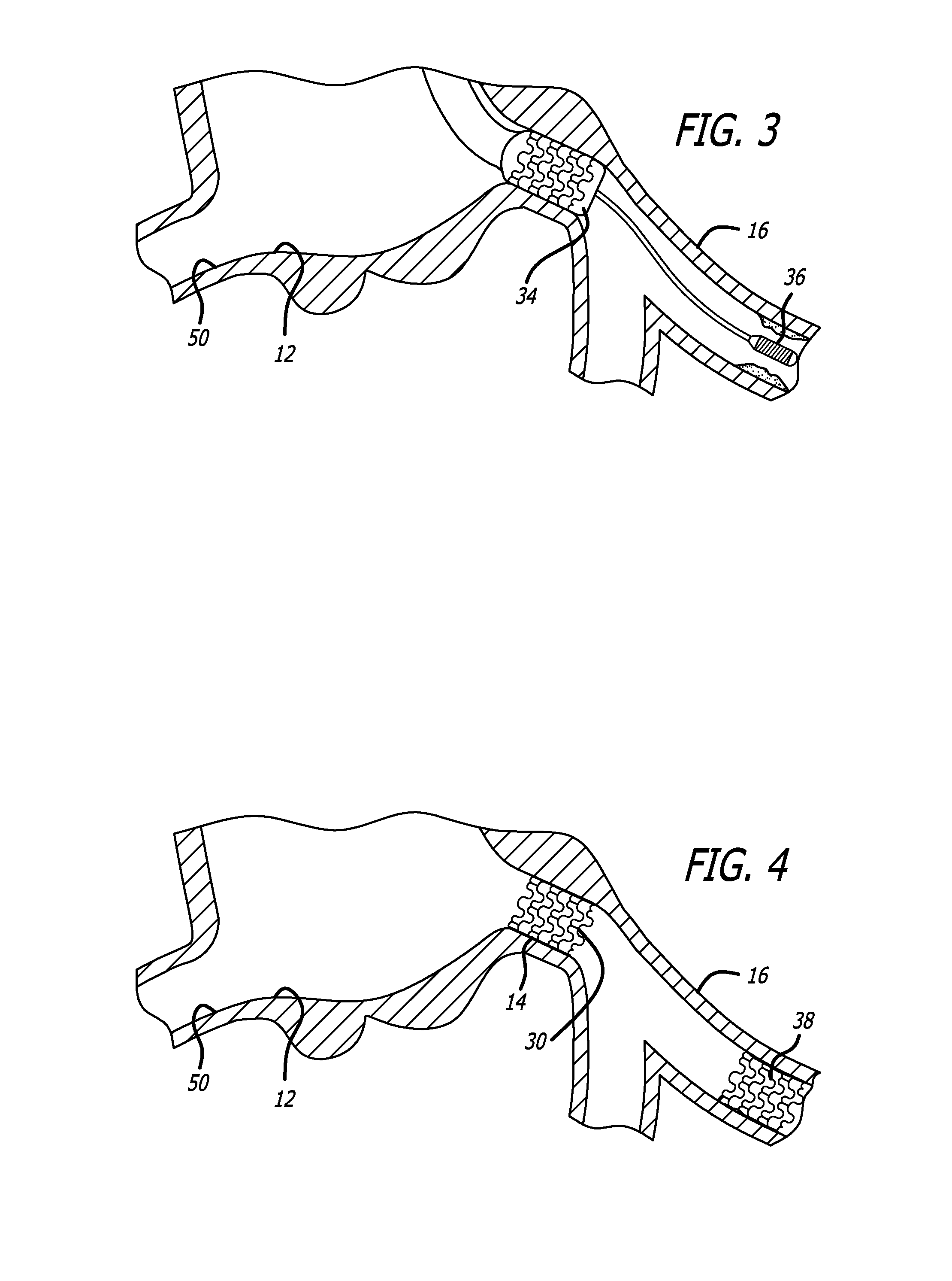 Methods for implanting a stent using a guide catheter