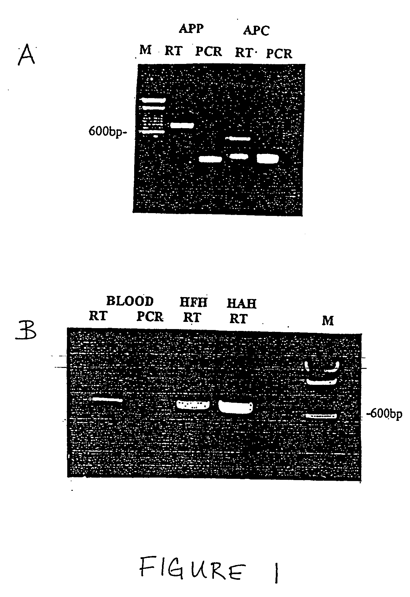 Method for the detection of coronary artery disease related gene transcripts in blood