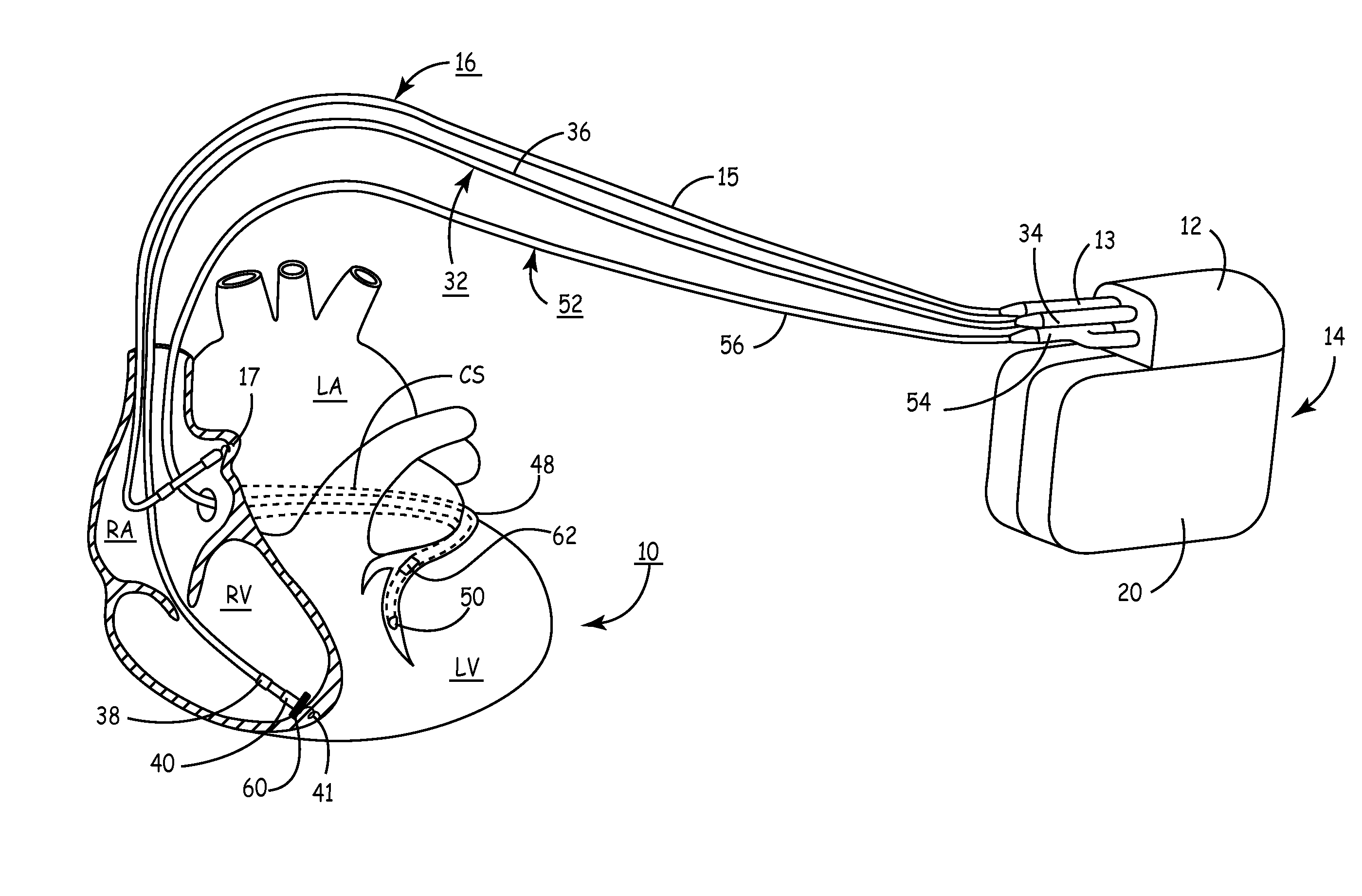 System and method for conditional biventricular pacing