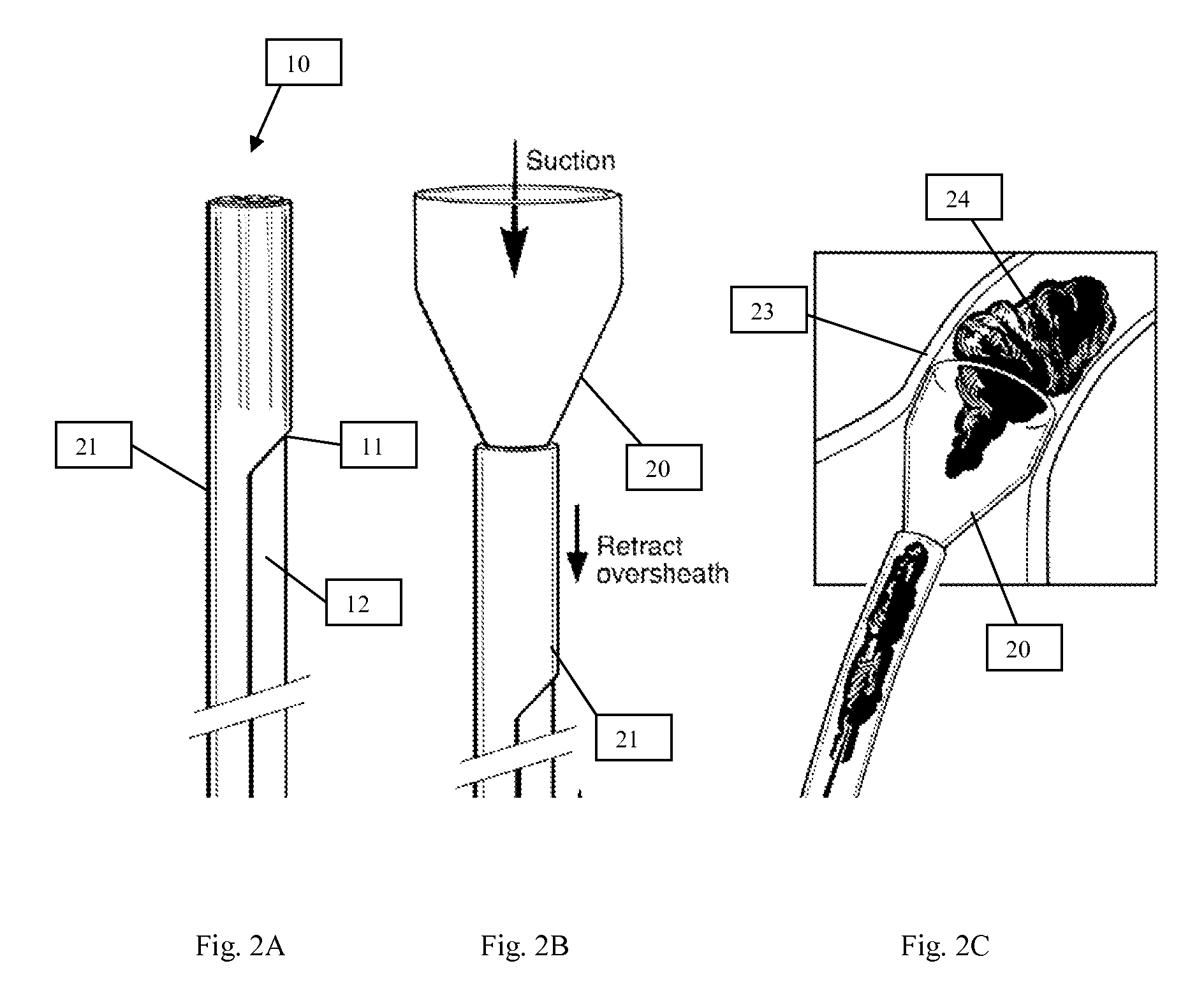 Systems and methods for removing undesirable material within a circulatory system utilizing a balloon catheter