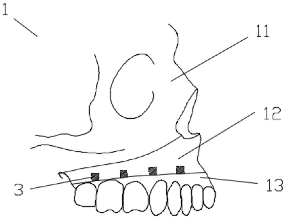 Orthognathic surgery teaching mold and use method thereof