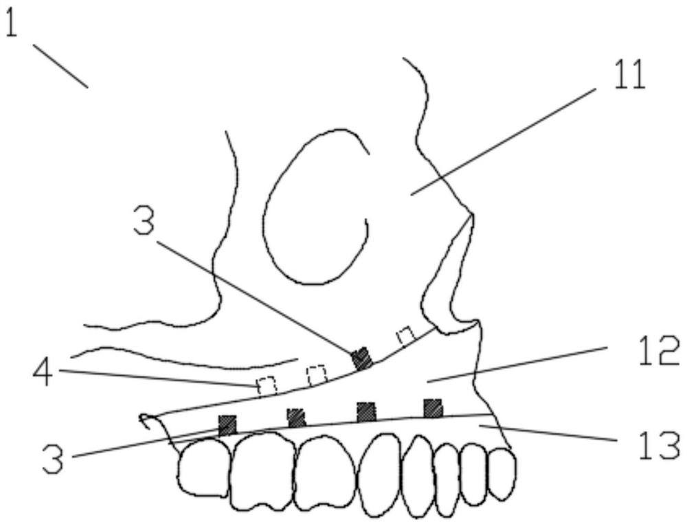 Orthognathic surgery teaching mold and use method thereof