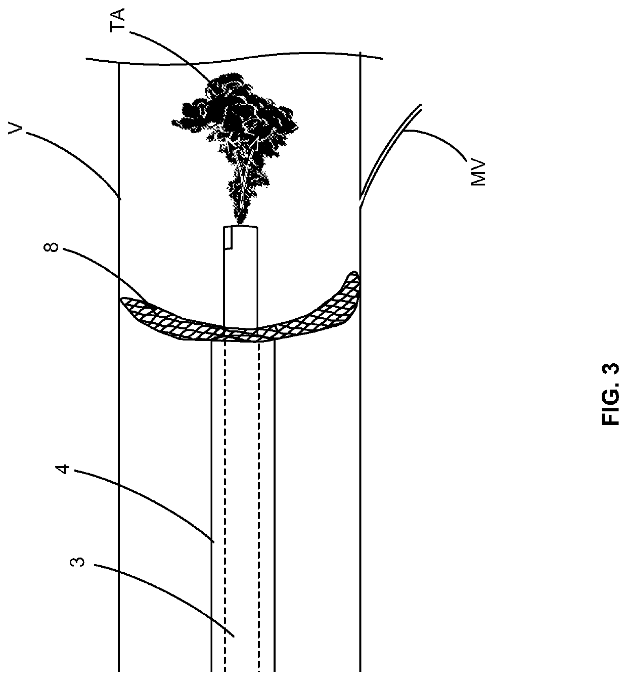 Sensor device and methods of operation for a catheter based treatment of myocardial microvascular obstruction