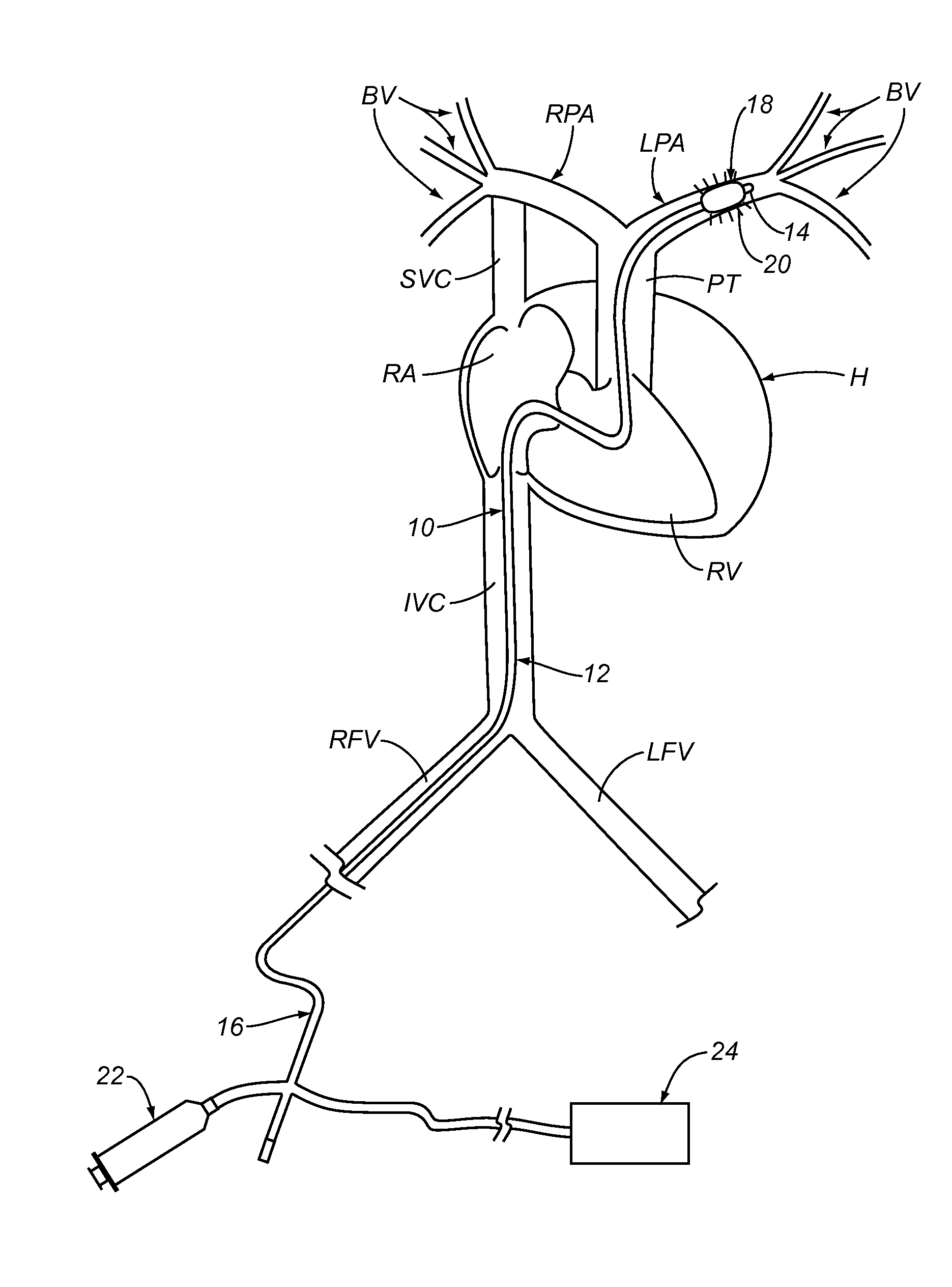 Apparatus and Methods For Treating Pulmonary Hypertension