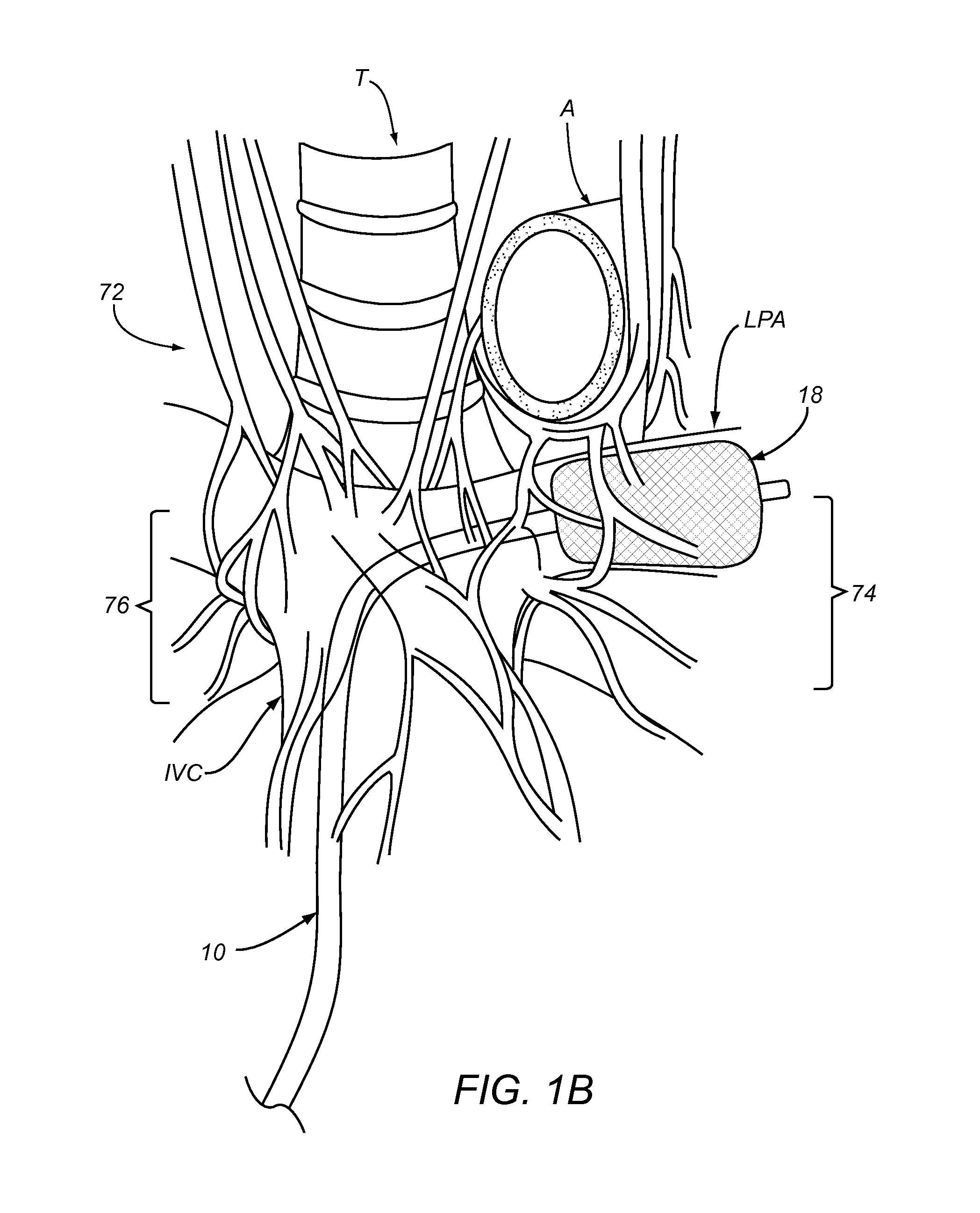Apparatus and Methods For Treating Pulmonary Hypertension