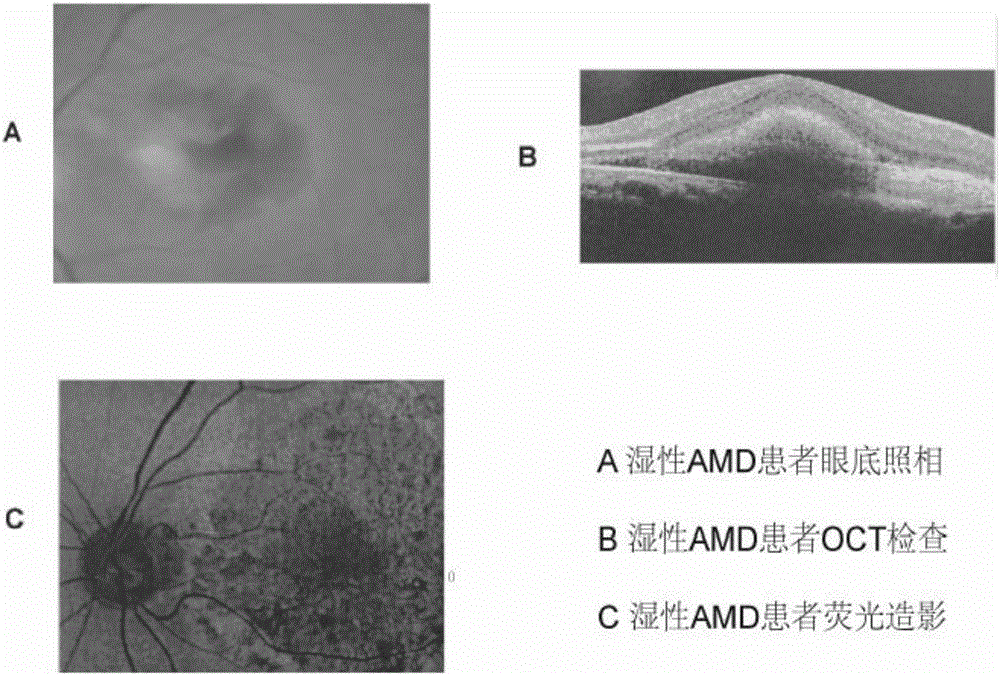 Application of circulating miRNA in serving as age-related macular degeneration diagnostic markers