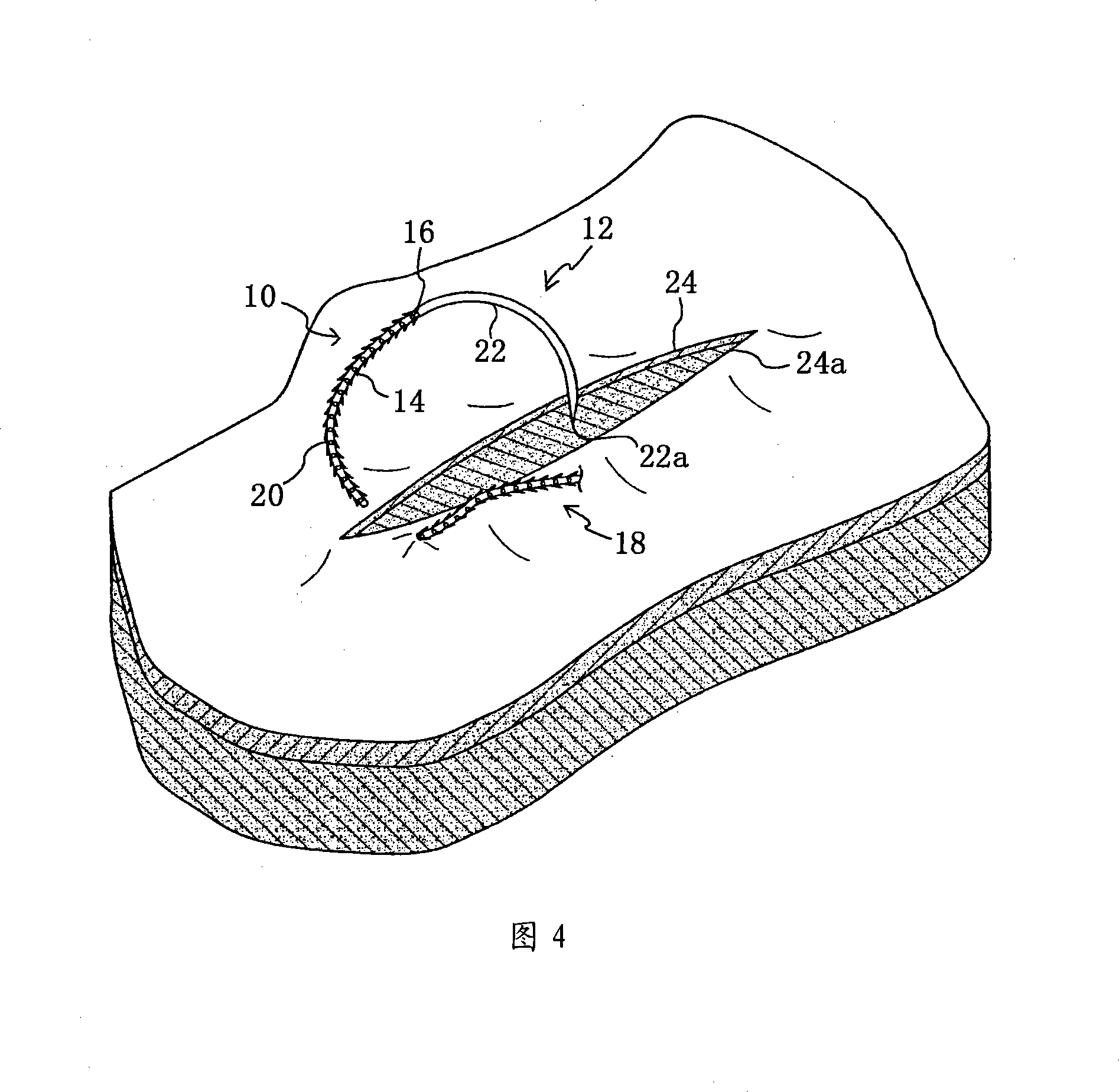Knotless wound closure device