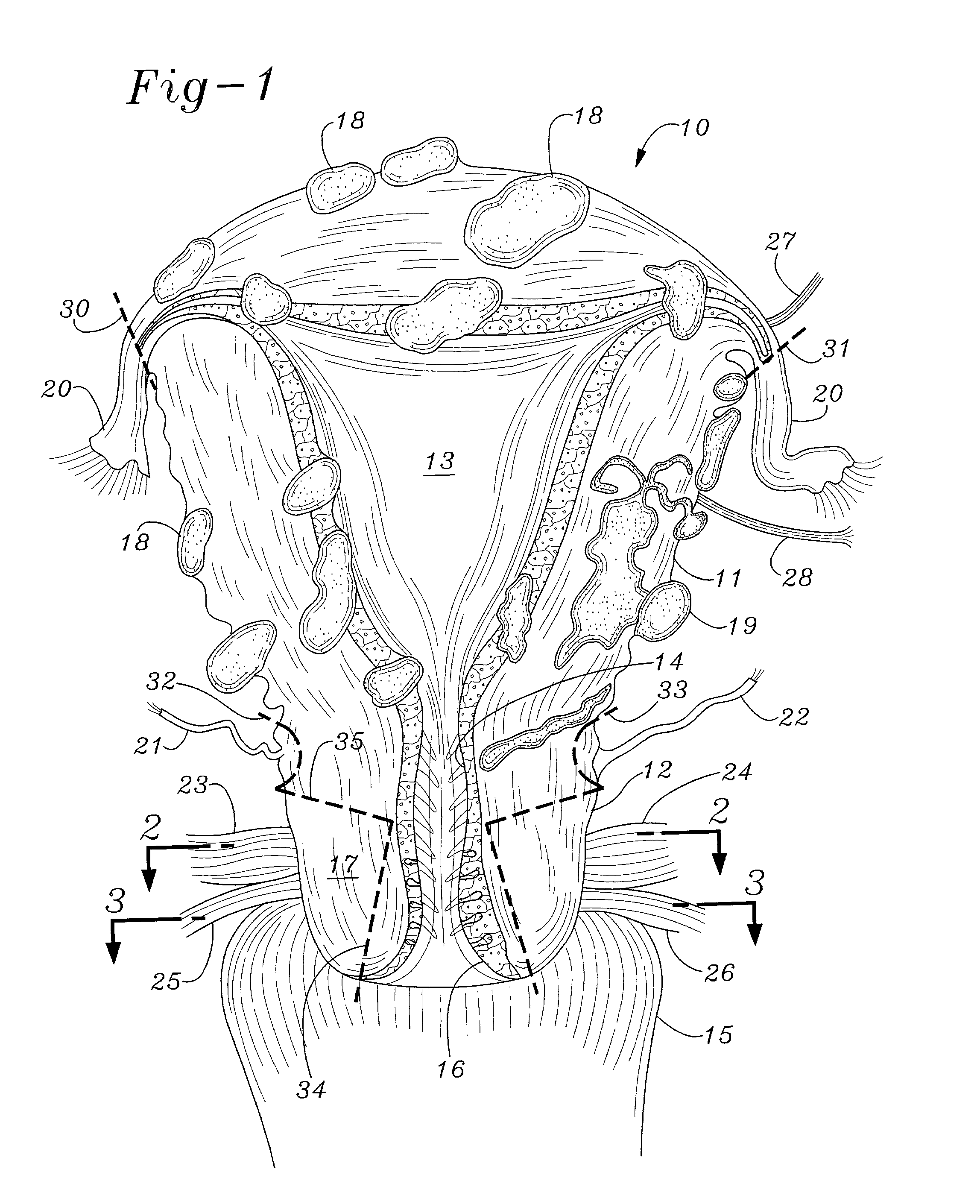 Method for performing a hysterectomy