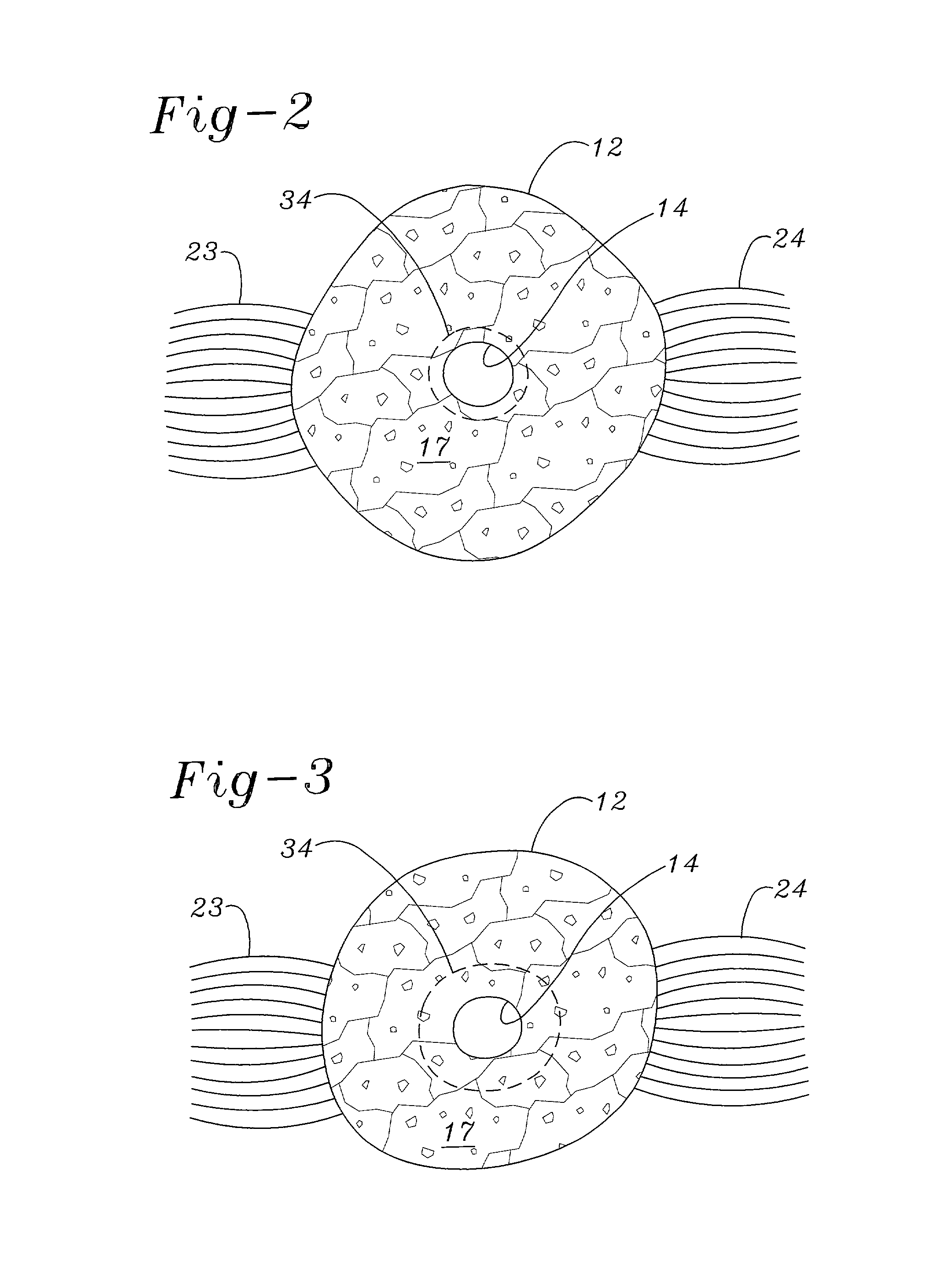 Method for performing a hysterectomy