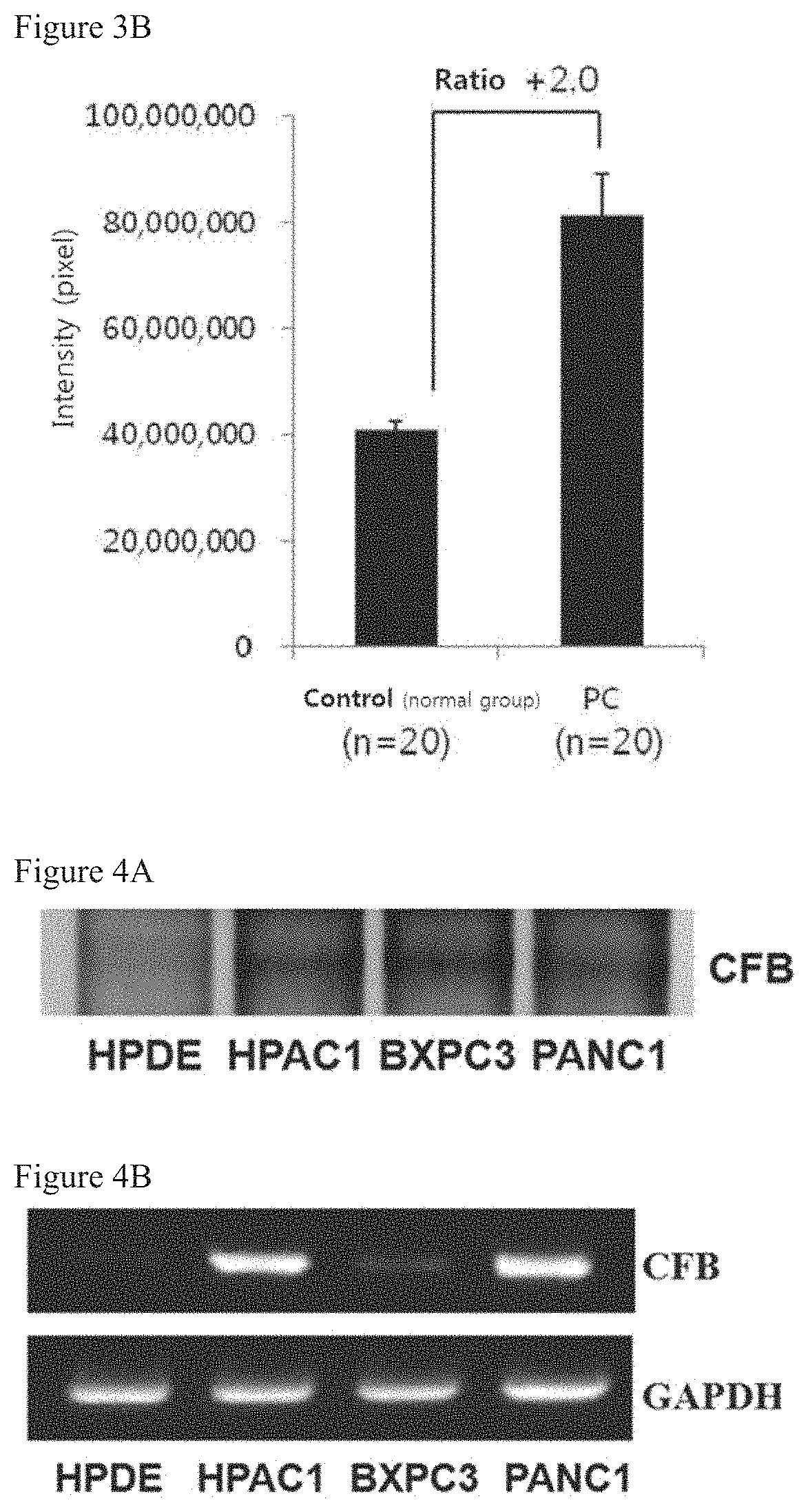Methods for detecting an amount of complement factor B protein and carbohydrate antigen 19-9 protein, and methods for diagnosing and treating pancreatic cancer using the same